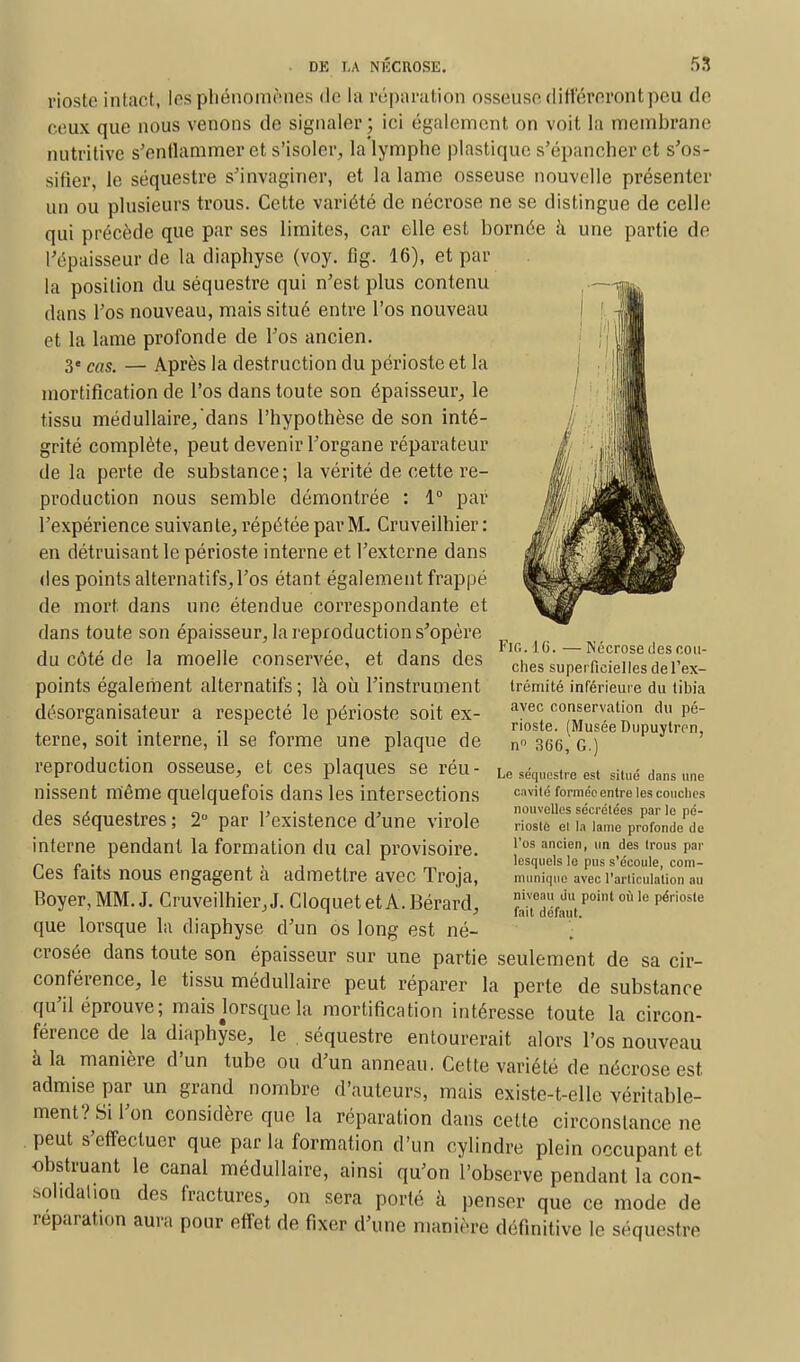 rioste intact, les phénomènes de la réparation osseuse différeront peu de ceux que nous venons de signaler; ici également on voit la membrane nutritive s'enflammer et s'isoler, la lymphe plastique s'épancher et s'os- sifier, le séquestre s'invaginer, et la lame osseuse nouvelle présenter un ou plusieurs trous. Cette variété de nécrose ne se distingue de celle qui précède que par ses limites, car elle est bornée à une partie de l'épaisseur de la diaphyse (voy. fig. 16), et par la position du séquestre qui n'est plus contenu dans l'os nouveau, mais situé entre l'os nouveau et la lame profonde de l'os ancien. 3« cas, — Après la destruction du périoste et la mortification de l'os dans toute son épaisseur, le tissu médullaire/dans l'hypothèse de son inté- grité complète, peut devenir l'organe réparateur de la perte de substance ; la vérité de cette re- production nous semble démontrée : 1° par l'expérience suivante, répétée par M- Cruveilhier: en détruisant le périoste interne et l'externe dans des points alternatifs, l'os étant également frappé de mort dans une étendue correspondante et dans toute son épaisseur, la reproduction s'opère du côté de la moelle conservée, et dans des points également alternatifs; là où l'instrument désorganisateur a respecté le périoste soit ex- terne, soit interne, il se forme une plaque de reproduction osseuse, et ces plaques se réu- nissent même quelquefois dans les intersections des séquestres ; 2° par l'existence d'une virole interne pendant la formation du cal provisoire. Ces faits nous engagent à admettre avec Troja, Boyer, MM. J. Cruveilhier, J. CloquetetA.Bérard, que lorsque la diaphyse d'un os long est né- crosée dans toute son épaisseur sur une partie seulement de sa cir- conférence, le tissu médullaire peut réparer la perte de substance qu'il éprouve; mais Jorsque la mortification intéresse toute la circon- férence de la diaphyse, le . séquestre entourerait alors l'os nouveau à la manière d'un tube ou d'un anneau. Cette variété de nécrose est admise par un grand nombre d'auteurs, mais existe-t-elle véritable- ment? Si l'on considère que la réparation dans cette circonstance ne peut s'effectuer que par la formation d'un cylindre plein occupant et obstruant le canal médullaire, ainsi qu'on l'observe pendant la con- sohdalion des fractures, on sera porté à penser que ce mode de réparation aura pour effet de fixer d'une manière définitive le séquestre FlG.16. —Nécrose des cou- ches superficielles del'ex- trémité inférieure du tibia avec conservation du pé- rioste. (Musée Dupuylren, n 3G6,' G.) Le séquestre esl situé dans une cavité formée entre les couches nouvelles sécrétées par le pé- rioste el la lame profonde de l'os ancien, un des trous par lesquels le pus s'écoule, com- munique avec l'articulation au nivoau du point où le périoste fait défaut.