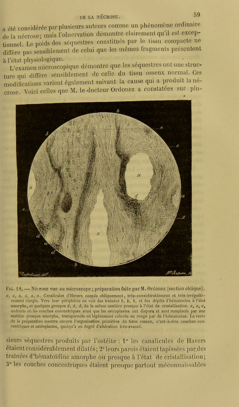 a été considérée par plusieurs auteurs comme un phénomène ordinaire de la nécrose; mais l'observation démontre clairement qu'il est excep- tionnel Le poids des séquestres constitués par le tissu compacte ne diffère pas sensiblement de celui que les mêmes fragments présentent à l'état physiologique. L'examen microscopique démontre que les séquestres ont une struc- ture qui diffère sensiblement de celle du tissu osseux normal. Ces modifications varient également suivant la cause qui a produiL la né- orose. Voici celles que M. le-docteur Ordonez a constatées sur plu- Fig. 18. — Nécrose vue au microscope ; préparation faite par M. Ordonez (section oblique). a, a, a, a, a, a, Canalicules d'Havers coupés obliquement, très-considérnlilement et très-irréguliè- rement élargis. Vers leur périphérie on voit des traînées b, b, b, et des dépôts d'hématosine à l'état amorphe, et quelques groupes d, d, d, de la même matière presque à l'élat de cristallisation, e, e, e, endroits où les couches concentriques ainsi que les ostéoplastes ont disparu et sont remplacés par une matière presque amorphe, transparente ou légèrement colorée en rouge par de l'hémalosino. Le reste de la préparation montre encore l'organisation primitive du tissu osseux, c'est-à-diro couches con- centriques et OBtéoplasles, quoiqu'à un degré d'altération très-avancé. sieurs séquestres produits par l'ostéite : 1° les canalicules de Havcrs étaient considérablement dilatés; 2° leurs parois étaient tapissées par des traînées d'hématoïdine amorphe ou presque iï l'état de cristallisation; 3° les couches concentriques étaient presque partout méconnaissables