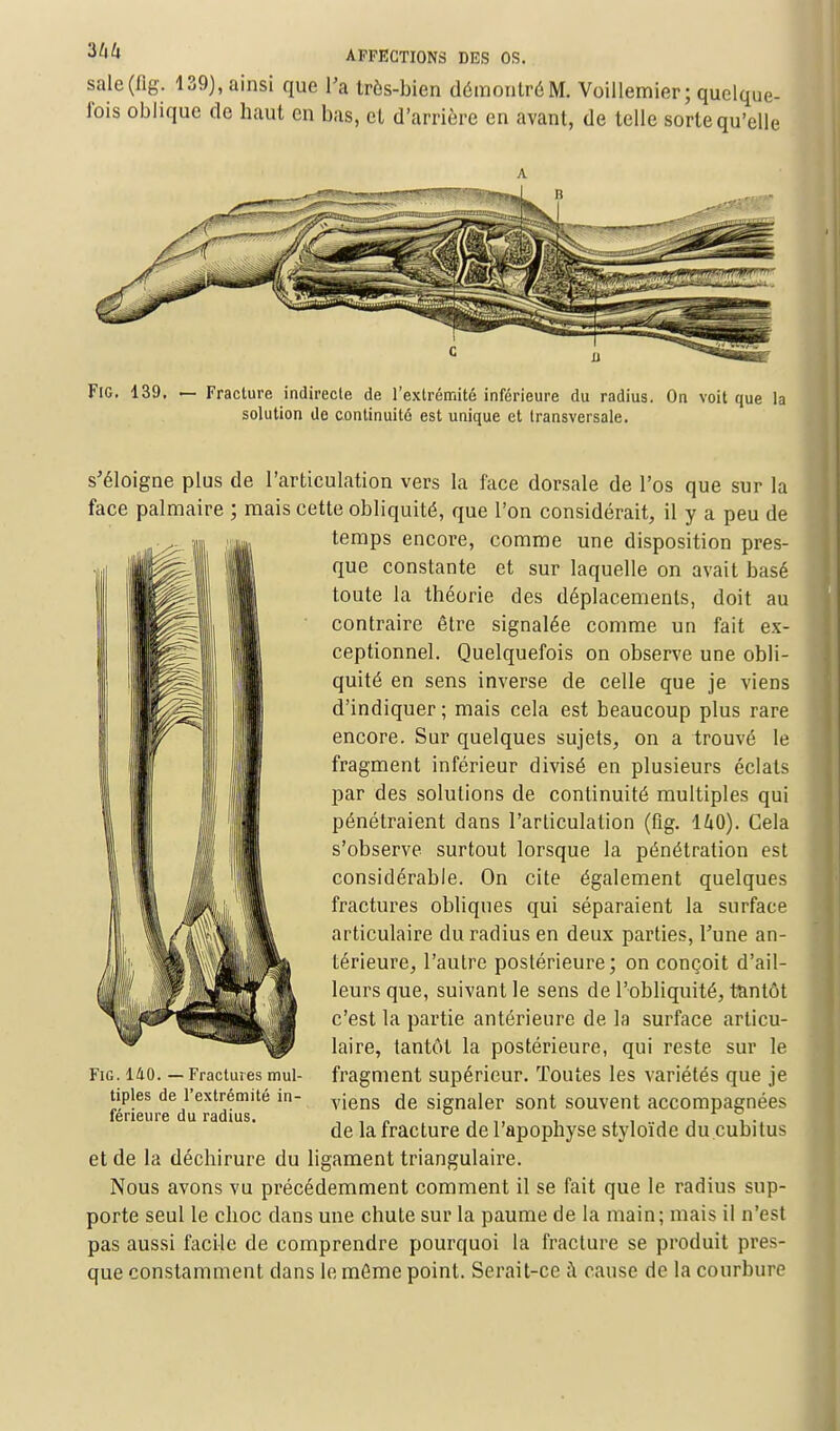 sàle(flg. 139), ainsi que l'a très-bien démontré M. Voillemier; quelque- fois oblique de haut en bas, et d'arrière en avant, de telle sorte qu'elle FlG. 139. — Fracture indirecte de l'extrémité inférieure du radius. On voit que la solution de continuité est unique et transversale. s'éloigne plus de l'articulation vers la face dorsale de l'os que sur la face palmaire ; mais cette obliquité, que l'on considérait, il y a peu de temps encore, comme une disposition pres- que constante et sur laquelle on avait basé toute la théorie des déplacements, doit au contraire être signalée comme un fait ex- ceptionnel. Quelquefois on observe une obli- quité en sens inverse de celle que je viens d'indiquer ; mais cela est beaucoup plus rare encore. Sur quelques sujets, on a trouvé le fragment inférieur divisé en plusieurs éclats par des solutions de continuité multiples qui pénétraient dans l'articulation (fig. 140). Cela s'observe surtout lorsque la pénétration est considérable. On cite également quelques fractures obliques qui séparaient la surface articulaire du radius en deux parties, l'une an- térieure, l'autre postérieure; on conçoit d'ail- leurs que, suivant le sens de l'obliquité, tantôt c'est la partie antérieure de la surface articu- laire, tantôt la postérieure, qui reste sur le fragment supérieur. Toutes les variétés que je viens de signaler sont souvent accompagnées de la fracture de l'apophyse styloïde du cubitus et de la déchirure du ligament triangulaire. Nous avons vu précédemment comment il se fait que le radius sup- porte seul le choc dans une chute sur la paume de la main; mais il n'est pas aussi facile de comprendre pourquoi la fracture se produit pres- que constamment dans le même point. Serait-ce à cause de la courbure FlG. 1Û0. — Fractures mul- tiples de l'extrémité in- férieure du radius.