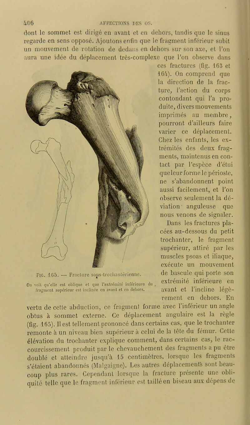 dont le sommet est dirigé en avant et en dehors, tandis que le sinus regarde en sens opposé. Ajoutons enfin que le fragment inférieur subit un mouvement de rotation de dedans en dehors sur son axe, et l'on aura une idée du déplacement très-complexe que l'on observe dans ces fractures (fig. 103 et ■W\). On comprend que la direction de la frac- ture, l'action du corps contondant qui l'a pro- duite, divers mouvements imprimés au membre, pourront d'ailleurs faire varier ce déplacement. Chez les enfants, les ex- trémités des deux frag- ments, maintenus en con- tact par l'espèce d'étui queleur forme le périoste, ne s'abandonnent point aussi facilement, et l'on observe seulement la dé- viation anguleuse que nous venons de signaler. Dans les fractures pla- cées au-dessous du petit trochanter, le fragment supérieur, attiré par les muscles psoas et iliaque, exécute un mouvement de bascule qui porte son extrémité inférieure en avant et l'incline légè- rement en dehors. En vertu de cette abduction, ce fragment forme avec l'inférieur un angle obtus à sommet externe. Ce déplacement angulaire est la règle (fig. 165). Il est tellement prononcé dans certains cas, que le trochanter remonte a un niveau bien supérieur à celui de la lête du fémur. Celte élévation du trochanter explique comment, dans certains cas, le rac- courcissement produit par le chevauchement des fragments a pu être doublé et atteindre jusqu'à 15 centimètres, lorsque les fragments s'étaient abandonnés (Malgaigne). Les autres déplacements sont beau- coup plus rares. Cependant lorsque la fracture présente une obli- quité telle que le fragment inférieur est taillé en biseau aux dépens de Fig. 165. — Fracture sous-trochanlérienne. On voit qu'elle est oblique et que l'extrémité inférieure du fragment supérieur est inclinée en avant et en dehors.