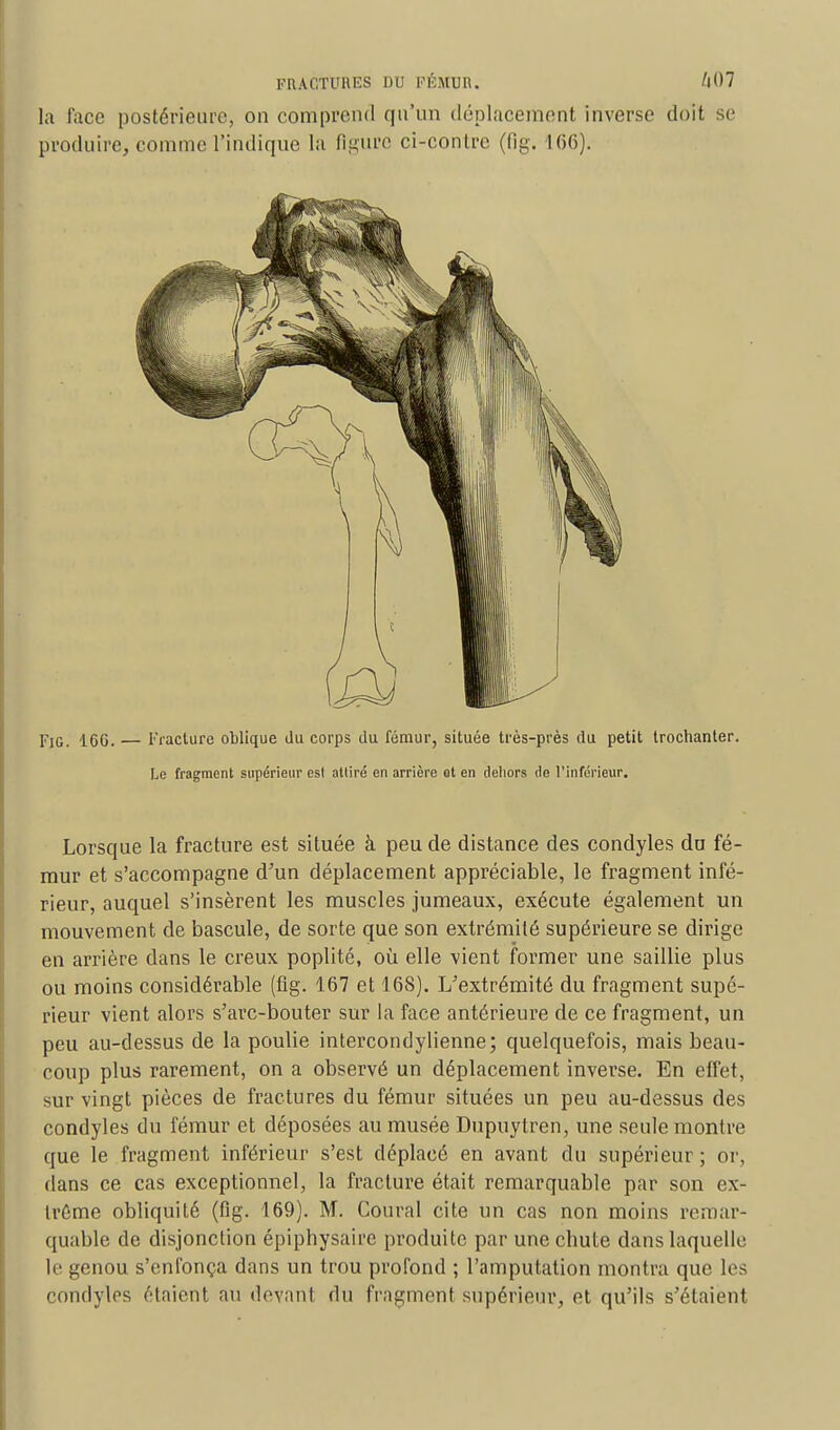 la face postérieure, on comprend qu'un déplacement inverse doit se produire, comme l'indique la figure ci-contre (fig. 166). FiG. 166. — Fracture oblique du corps du fémur, située très-près du petit trochanter. Le fragment supérieur esl attiré en arrière et en dehors de l'inférieur. Lorsque la fracture est située à peu de distance des condyles du fé- mur et s'accompagne d'un déplacement appréciable, le fragment infé- rieur, auquel s'insèrent les muscles jumeaux, exécute également un mouvement de bascule, de sorte que son extrémité supérieure se dirige en arrière dans le creux poplité, où elle vient former une saillie plus ou moins considérable (fig. 167 et 16S). L'extrémité du fragment supé- rieur vient alors s'arc-bouter sur la face antérieure de ce fragment, un peu au-dessus de la poulie intercondylienne; quelquefois, mais beau- coup plus rarement, on a observé un déplacement inverse. En effet, sur vingt pièces de fractures du fémur situées un peu au-dessus des condyles du fémur et déposées au musée Dupuytren, une seule montre que le fragment inférieur s'est déplacé en avant du supérieur ; or, dans ce cas exceptionnel, la fracture était remarquable par son ex- trême obliquité (fig. 169). M. Coural cite un cas non moins remar- quable de disjonction épiphysaire produite par uneebute dans laquelle le genou s'enfonça dans un trou profond ; l'amputation montra que les condyles étaient au devant du fragment supérieur, et qu'ils s'étaient