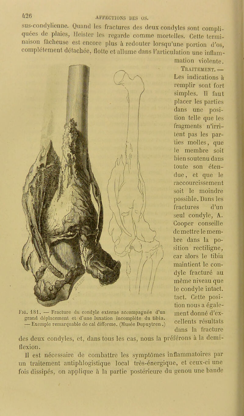 sus-condylienne. Quand les fractures dos doux condyles sont compli- quées de plaies, Heister les regarde comme mortelles. Celte termi- naison fâcheuse est encore plus à redouter lorsqu'une portion d'os, complétemenl détachée, (lotte et allume dans l'articulation une inflam - mation violente. Traitement. — Les indications à remplir sont fort simples. Il faut placer les parties dans une posi- tion telle que les fragments n'irri- tent pas les par- ties molles, que le membre soit bien soutenu dans toute son éten- due , et que le raccourcissement soit le moindre possible. Dans les fractures d'un seul condyle, A. Gooper conseille démettre le mem- bre dans la po- sition rectiligne, car alors le tibia maintient le con- dyle fracturé au même niveau que le condyle intact, tact. Cette posi- tion nous a égale- ment donné d'ex- cellents résultats dans la fracture des deux condyles, et, dans tous les cas, nous la préférons à la demi- flexion. 11 est nécessaire de combattre les symptômes inflammatoires par un traitement antiphlogistique local très-énergique, et ceux-ci une fois dissipés, on applique à la partie postérieure du genou une bande Fjg. 181. — Fracture du condyle externe accompagnée d'un grand déplacement et d'une luxation incomplète du tibia. ;—Exemple remarquable de cal difforme. (Musée Dupuylrcn.)