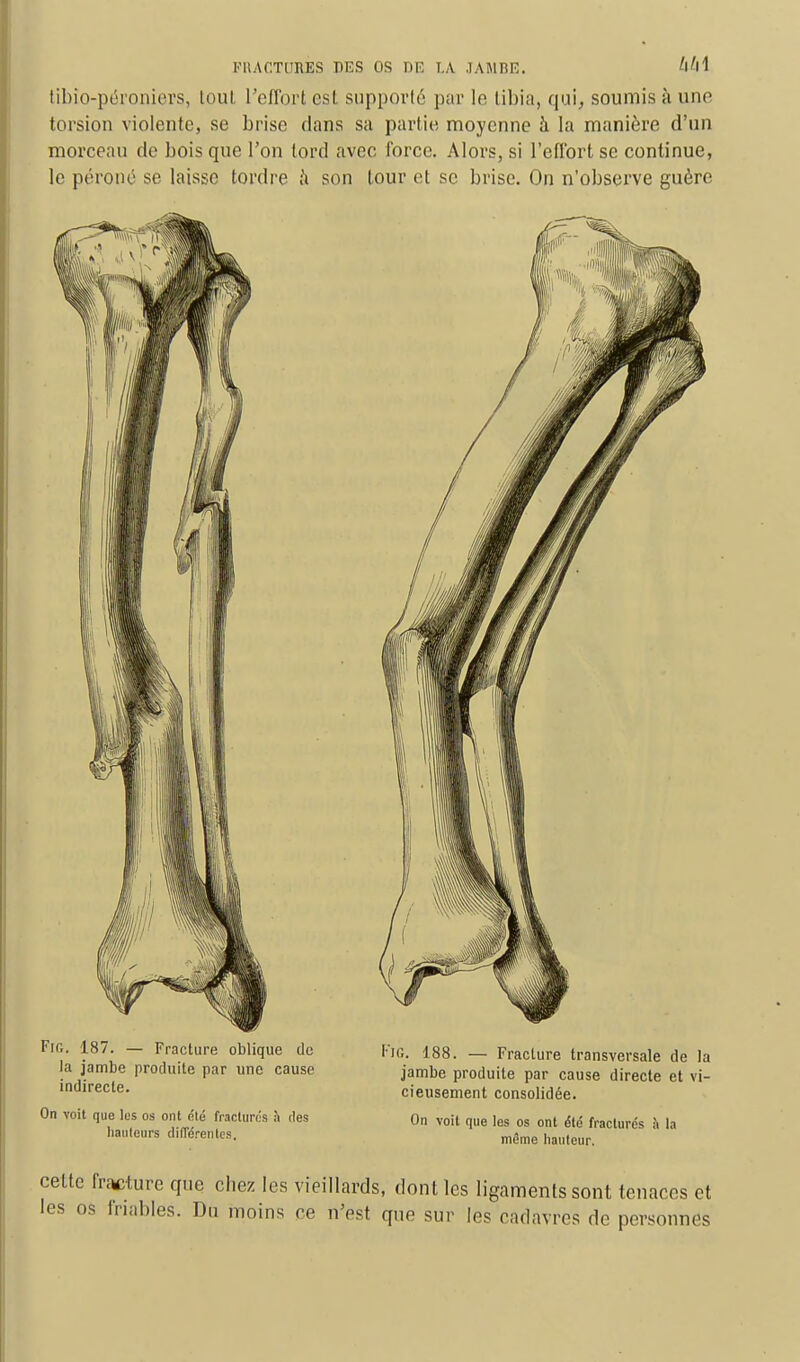 tibio-péroniers, touL l'effort est supporté par le tibia, qui, soumis à une torsion violente, se brise dans sa partie moyenne à la manière d'un morceau de bois que l'on tord avec force. Alors, si l'effort se continue, le péroné se laisse tordre à son tour et se brise. On n'observe guère Fig. 187. — Fracture oblique de la jambe produite par une cause indirecte. On voit que les os ont été fracturés à des hauteurs différentes. FlG. 188. — Fracture transversale de la jambe produite par cause directe et vi- cieusement consolidée. On voit que les os ont été fracturés h la môme hauteur. cette fracture que chez les vieillards, dont les ligaments sont tenaces et les os friables. Du moins ce n'est que sur les cadavres de personnes