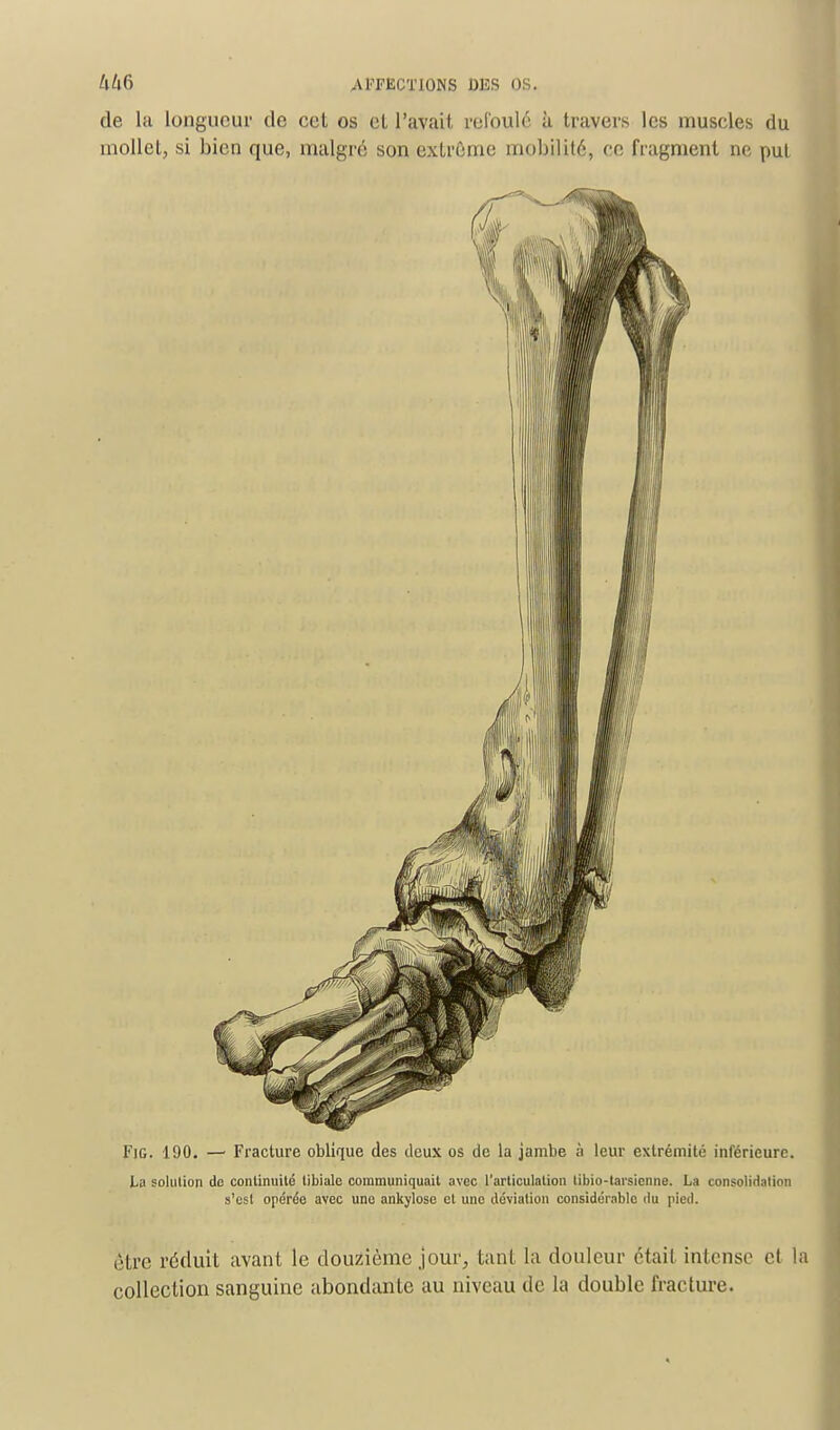 de la longueur de cet os el l'avait refoulé à travers les muscles du mollet, si bien que, malgré son extrême mobilité, ce fragment ne put Fig. 190. — Fracture oblique des deux os de la jambe à leur extrémité inférieure. La solution de continuité libiale communiquait avec l'articulation tibio-taisicnne. La consolidation s'est opérée avec une ankylose cl une déviation considérable du pied. être réduit avant le douzième jour, tant la douleur était intense el la collection sanguine abondante au niveau de la double fracture.