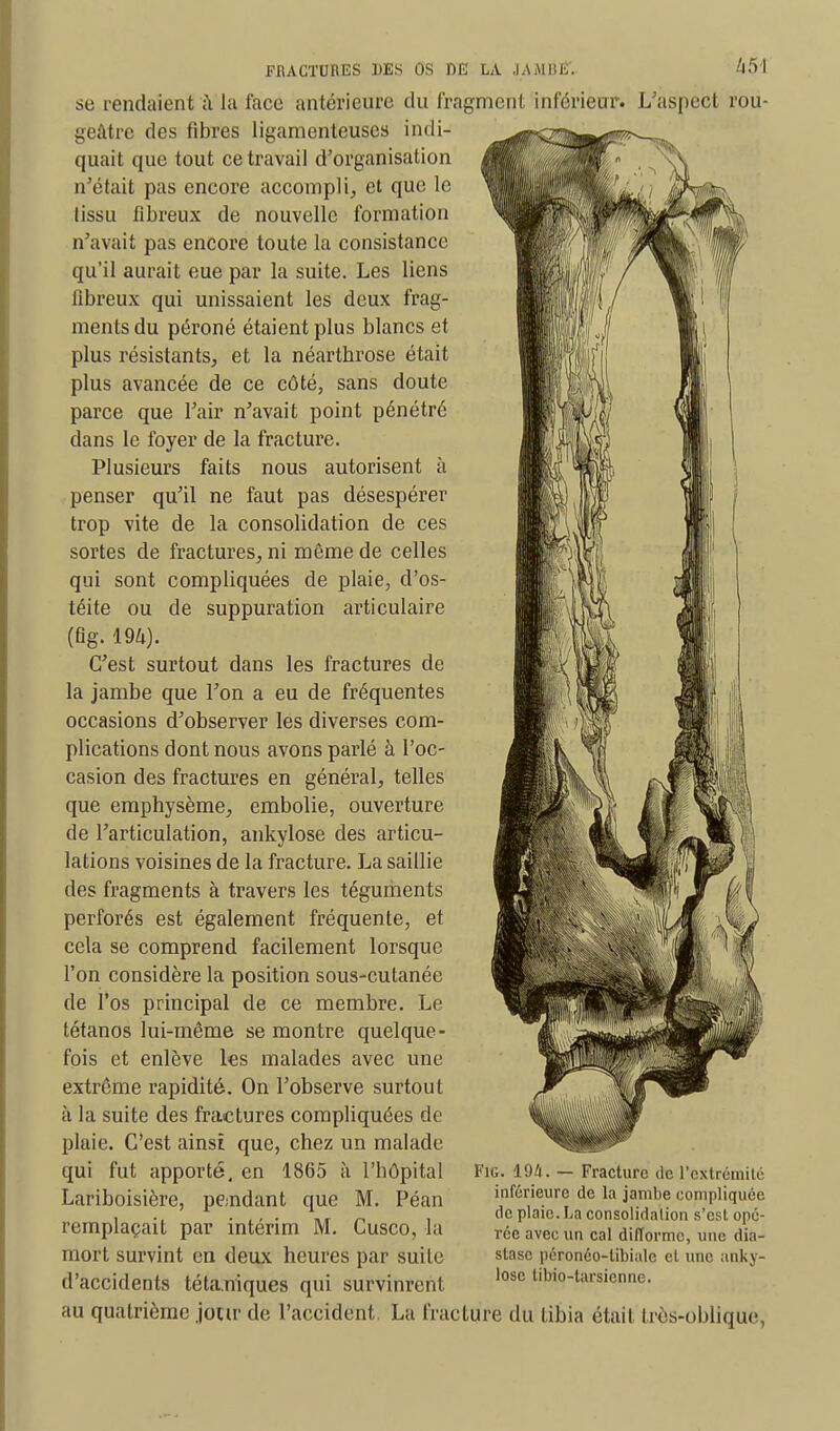 se rendaient à la face antérieure du fragment inférieur. L'aspect rou- geâtre des fibres ligamenteuses indi- quait que tout ce travail d'organisation n'était pas encore accompli, et que le lissu fibreux de nouvelle formation n'avait pas encore toute la consistance qu'il aurait eue par la suite. Les liens fibreux qui unissaient les deux frag- ments du péroné étaient plus blancs et plus résistants, et la néartbrose était plus avancée de ce côté, sans doute parce que l'air n'avait point pénétré dans le foyer de la fracture. Plusieurs faits nous autorisent à penser qu'il ne faut pas désespérer trop vite de la consolidation de ces sortes de fractures, ni même de celles qui sont compliquées de plaie, d'os- téite ou de suppuration articulaire (6g. 194). C'est surtout dans les fractures de la jambe que l'on a eu de fréquentes occasions d'observer les diverses com- plications dont nous avons parlé à l'oc- casion des fractures en général, telles que emphysème, embolie, ouverture de l'articulation, ankylose des articu- lations voisines de la fracture. La saillie des fragments à travers les téguments perforés est également fréquente, et cela se comprend facilement lorsque l'on considère la position sous-cutanée de l'os principal de ce membre. Le tétanos lui-même se montre quelque- fois et enlève les malades avec une extrême rapidité. On l'observe surtout à la suite des fractures compliquées de plaie. C'est ainsi que, chez un malade qui fut apporté, en 1865 à l'hôpital Lariboisière, pendant que M. Péan remplaçait par intérim M. Cusco, la mort survint en deux heures par suile d'accidents tétaniques qui survinrent au quatrième jour de l'accident. La fracture du tibia était très-oblique, Fie. 194. — Fracture de l'extrémité inférieure de la jambe compliquée de plaie. La consolidation s'est opé- rée avec un cal difforme, une dia- slasc péronéo-libiale et une anky- lose tibio-tarsienne.