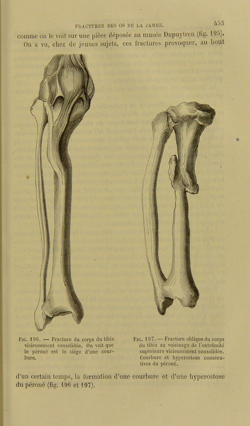 FHACTURliS DES OS DE l.A JAMBE. comme on le voit sur une pièce déposée au musée Dupuylrcn (tig. 195J. On a vu, chez de jeunes sujets, ces fractures provoquer, au bout FiG. 196. — Fracture du corps du libia vicieusement consolidée. On voit que le péroné est le siège d'une cour- bure. Fie. 197. — Fracture oblique du corps du tibia au voisinage de l'extrémité supérieure vicieusement consolidée. Courbure et hyperostose consécu- tives du péroné. d'un certain temps, la formation d'une courbure et d'une hyperostose du péroné (fig. 496 et 107).