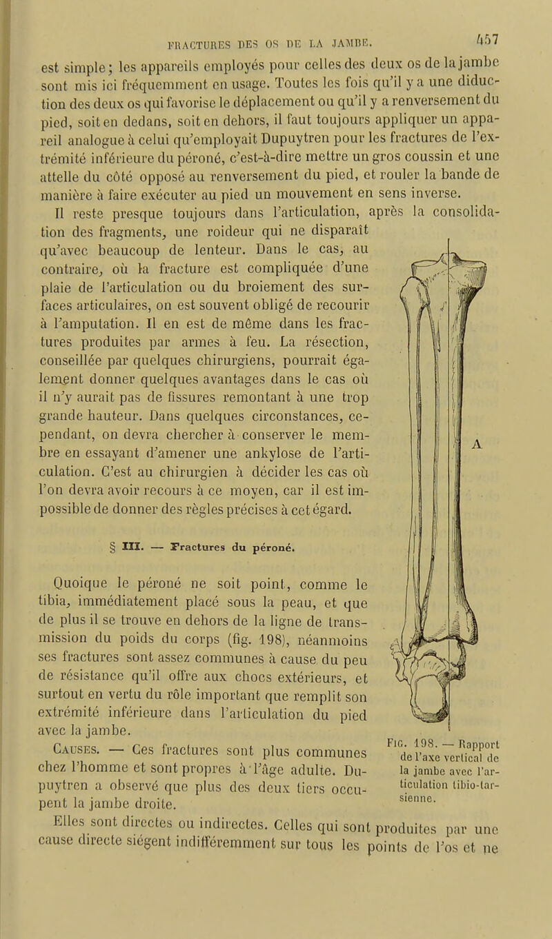 est simple; les appareils employés pour celles des deux os de la jambe sont mis ici fréquemment en usage. Toutes les fois qu'il y a une diduc- tion des deux os qui favorise le déplacement ou qu'il y a renversement du pied, soit en dedans, soit en dehors, il faut toujours appliquer un appa- reil analogue à celui qu'employait Dupuytren pour les fractures de l'ex- trémité inférieure du péroné, c'est-à-dire mettre un gros coussin et une attelle du côté opposé au renversement du pied, et rouler la bande de manière à faire exécuter au pied un mouvement en sens inverse. Il reste presque toujours dans l'articulation, après la consolida- tion des fragments, une roideur qui ne disparaît qu'avec beaucoup de lenteur. Dans le cas, au contraire, où la fracture est compliquée d'une plaie de l'articulation ou du broiement des sur- faces articulaires, on est souvent obligé de recourir à l'amputation. Il en est de même dans les frac- tures produites par armes à feu. La résection, conseillée par quelques chirurgiens, pourrait éga- lement donner quelques avantages dans le cas où il n'y aurait pas de fissures remontant à une trop grande hauteur. Dans quelques circonstances, ce- pendant, on devra chercher à conserver le mem- bre en essayant d'amener une ankylose de l'arti- culation. C'est au chirurgien à décider les cas où l'on devra avoir recours à ce moyen, car il est im- possible de donner des règles précises à cet égard. § III- — Tractures du péroné. Quoique le péroné ne soit point, comme le tibia, immédiatement placé sous la peau, et que de plus il se trouve en dehors de la ligne de trans- mission du poids du corps (fig. 198), néanmoins ses fractures sont assez communes à cause du peu de résistance qu'il offre aux chocs extérieurs, et surtout en vertu du rôle important que remplit son extrémité inférieure dans l'arliculation du pied avec la jambe. Causes. — Ces fractures sont plus communes chez l'homme et sont propres à l'âge adulte. Du- puytren a observé que plus des deux tiers occu- pent la jambe droite. Elles sont directes ou indirectes. Celles qui sont produites par une cause directe siègent indifféremment sur tous les points de l'os et ne FlC. 198. — Rapport de l'axe vertical de la jambe avec l'ar- ticulation tibio-lar- sienne.