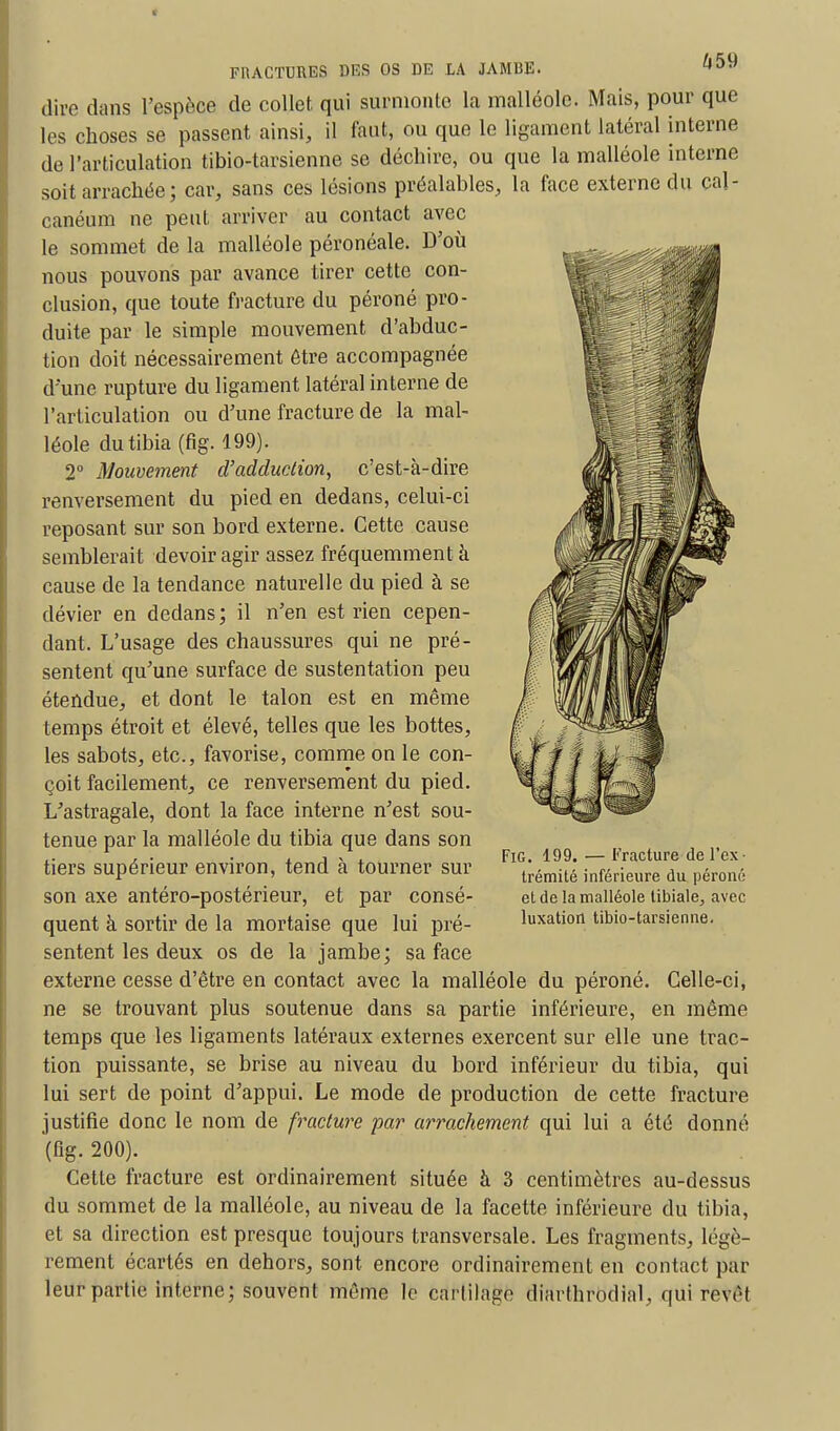 dire dans l'espèce de collet qui surmonte la malléole. Mais, pour que les choses se passent ainsi, il faut, ou que le ligament latéral interne de l'articulation tibio-tarsienne se déchire, ou que la malléole interne soit arrachée ; car, sans ces lésions préalables, la face externe du cal- canéum ne peut arriver au contact avec le sommet de la malléole péronéale. D'où nous pouvons par avance tirer cette con- clusion, que toute fracture du péroné pro- duite par le simple mouvement d'abduc- tion doit nécessairement être accompagnée d'une rupture du ligament latéral interne de l'articulation ou d'une fracture de la mal- léole du tibia (fig. 199). 2° Mouvement d'adduction, c'est-à-dire renversement du pied en dedans, celui-ci reposant sur son bord externe. Cette cause semblerait devoir agir assez fréquemment à cause de la tendance naturelle du pied à se dévier en dedans; il n'en est rien cepen- dant. L'usage des chaussures qui ne pré- sentent qu'une surface de sustentation peu étendue, et dont le talon est en même temps étroit et élevé, telles que les bottes, les sabots, etc., favorise, comme on le con- çoit facilement, ce renversement du pied. L'astragale, dont la face interne n'est sou- tenue par la malléole du tibia que dans son tiers supérieur environ, tend à tourner sur son axe antéro-postérieur, et par consé- quent à sortir de la mortaise que lui pré- sentent les deux os de la jambe; sa face externe cesse d'être en contact avec la malléole du péroné. Celle-ci, ne se trouvant plus soutenue dans sa partie inférieure, en même temps que les ligaments latéraux externes exercent sur elle une trac- tion puissante, se brise au niveau du bord inférieur du tibia, qui lui sert de point d'appui. Le mode de production de cette fracture justifie donc le nom de fracture par arrachement qui lui a été donné (fig. 200). Cette fracture est ordinairement située à 3 centimètres au-dessus du sommet de la malléole, au niveau de la facette inférieure du tibia, et sa direction est presque toujours transversale. Les fragments, légè- rement écartés en dehors, sont encore ordinairement en contact par leur partie interne; souvent même le cartilage diarthrodial, qui revêt Fig. 199. — Fracture de l'ex • trémité inférieure du péroné et de la malléole tibiale, avec luxation tibio-tarsienne.