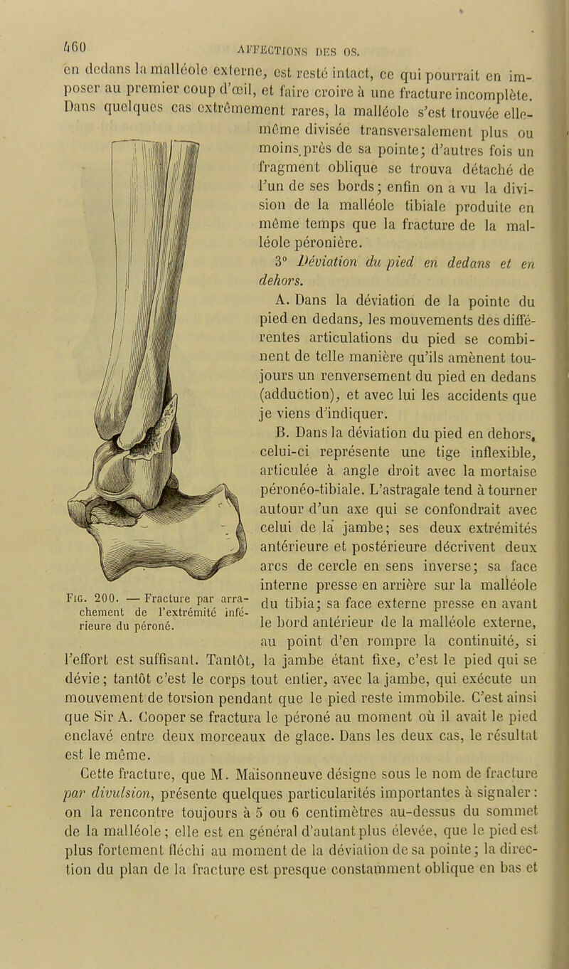 en dedans la malléole cxlerne, est resté intact, ce qui pourrait en im- poser au premier coup d'œil, et faire croire à une fracture incomplète. Dans quelques cas extrêmement rares, la malléole s'est trouvée elle- même divisée transversalement plus ou moins près de sa pointe; d'autres fois un fragment oblique se trouva détaché de l'un de ses bords; enfin on a vu la divi- sion de la malléole tibiale produite en môme temps que la fracture de la mal- léole péronière. 3° Déviation du pied en dedans et en dehors. A. Dans la déviation de la pointe du pied en dedans, les mouvements des diffé- rentes articulations du pied se combi- nent de telle manière qu'ils amènent tou- jours un renversement du pied en dedans (adduction), et avec lui les accidents que je viens d'indiquer. B. Dans la déviation du pied en dehors, celui-ci représente une tige inflexible, articulée à angle droit avec la mortaise péronéo-tibiale. L'astragale tend à tourner autour d'un axe qui se confondrait avec celui de là jambe; ses deux extrémités antérieure et postérieure décrivent deux arcs de cercle en sens inverse; sa face interne presse en arrière sur la malléole du tibia; sa face externe presse en avant le bord antérieur de la malléole externe, au point d'en rompre la continuité, si l'effort est suffisant. Tantôt, la jambe étant fixe, c'est le pied qui se dévie ; tantôt c'est le corps tout entier, avec la jambe, qui exécute un mouvement de torsion pendant que le pied reste immobile. C'est ainsi que Sir A. Cooper se fractura le péroné au moment où il avait le pied enclavé entre deux morceaux de glace. Dans les deux cas, le résultat est le même. Cette fracture, que M. Maisonneuve désigne sous le nom de fracture par divulsion, présente quelques particularités importantes à signaler : on la rencontre toujours à 5 ou 6 centimètres au-dessus du sommet de la malléole ; elle est en général d'autant plus élevée, que le pied est plus fortement fléchi au moment de la déviation de sa pointe; la direc- tion du plan de la fracture est presque constamment oblique en bas et Fie 200. — Fracture par arra- chement de l'extrémité infé- rieure du péroné.