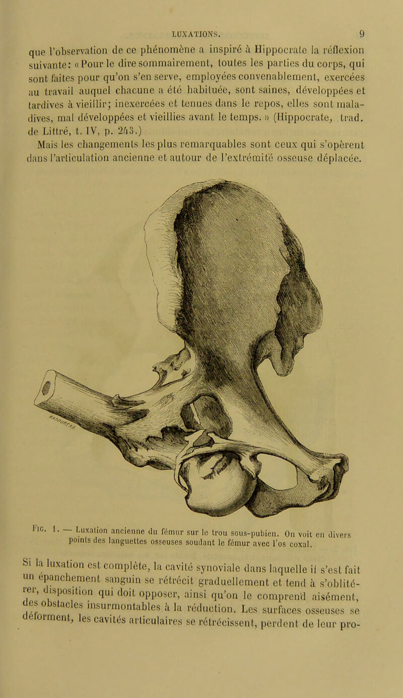 que l'observation de ce phénomène a inspiré à Hippocrale la réflexion suivante: « Pour le dire sommairement, toutes les parties du corps, qui sont laites pour qu'on s'en serve, employées convenablement, exercées au travail auquel chacune a été habituée, sont saines, développées et tardives à vieillir; inexercées et tenues dans le repos, elles sont mala- dives, mal développées et vieillies avant le temps. » (Hippoeratej trad. de Littré, t. IV, p. 243.) Mais les changements les plus remarquables sont ceux qui s'opèrent dans l'articulation ancienne et autour de l'extrémité osseuse déplacée. FlC 1. — Luxation ancienne du fémur sur le trou sous-pubien. On voit en divers points des languettes osseuses soudant le fémur avec l'os coxal. Si la luxation est complète, la cavité synoviale dans laquelle il s'esl l'ail un epanchement sanguin se rétrécit graduellement et tend à s'oblité- rer, disposition qui doit opposer, ainsi qu'on le comprend aisément, ues obstacles insurmontables à la réduction. Les surfaces osseuses se aeiorment, les cav.tés articulaires se rétrécissent, perdent de leur pro-
