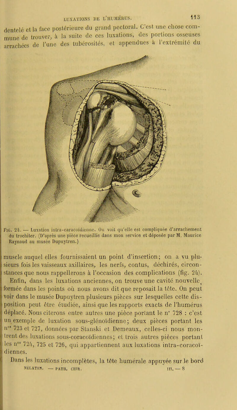 dentelé et la face postérieure du grand pectoral. C'est une chose com- mune de trouver, à la suite de ces luxations, des portions osseuses arrachées de l'une des tubérosilés, et appendues à l'extrémité du Fig. 24. — Luxation intra-caracoïdienne. On voit qu'elle est compliquée d'arrachement du trochiter. (D'après une pièce recueillie dans mon service et déposée par M. Maurice Raynaud au musée Dupuytren.) muscle auquel elles fournissaient un point d'insertion; on a vu plu- sieurs fois les vaisseaux axillaires, les nerfs, contus, déchirés, circon- stances que nous rappellerons à l'occasion des complications (fig. 24). Enfin, dans les luxations anciennes, on trouve une cavité nouvelle^ formée dans les points où nous avons dit que reposait la téte. On peut voir dans le musée Dupuytren plusieurs pièces sur lesquelles cette dis- position peut être étudiée, ainsi que les rapports exacts de l'humérus déplacé. Nous citerons entre autres une pièce portant le n° 728 : c'est un exemple de luxation sous-glénoïdienne; deux pièces portant les n°5 723 et 727, données par Stanski et Demeaux, celles-ci nous mon- trent des luxations sous-coracoïdiennes; et trois autres pièces portant les n08 72/i, 725 et 726, qui appartiennent aux luxations intra-coracoï- diennes. Dans les luxations incomplètes, la tête humérale appuyée sur le bord NÉLATOH. — PATH. CII1R. III. — 8