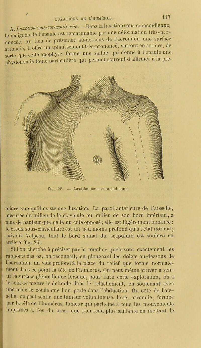 A Luxation sous-coracoïdienne.—li^s la luxation sous-coracoïdienne, le moi-non de l'épaule est remarquable par une déformation très-pro- noncée0 Au lieu de présenter au-dessous de l'acromion une surface arrondie il offre un aplatissement très-prononcé, surtout en arrière, de sorte que cette apophyse forme une saillie qui donne à l'épaule une physionomie toute particulière qui permet souvent d'affirmer a la pre- Fie. 25. — Luxation sous-coracoïdiennc. mière vue qu'il existe une luxation. La paroi antérieure de l'aisselle, mesurée du milieu de la clavicule au milieu de son bord inférieur, a plus de hauteur que celle du côté opposé ; elle est légèrement bombée : le creux sous-claviculaire est un peu moins profond qu'à l'état normal ; suivant Velpeau, tout le bord spinal du scapulum est soulevé en arrière (fig. 25). Si l'on cherche à préciser par le toucher quels sont exactement les rapports des os, on reconnaît, en plongeant les doigts au-dessous de l'acromion, un vide profond à la place du relief que forme normale- ment dans ce point la tête de l'humérus. On peut même arriver à sen- tir la surface glénoïdienne lorsque, pour faire cette exploration, on a le soin de mettre le deltoïde dans le relâchement, en soutenant avec une main le coude que l'on porte dans l'abduction. Du côté de l'ais- selle, on peut sentir une tumeur volumineuse, lisse, arrondie, formée par la tête de l'humérus, tumeur qui participe à tous les mouvements imprimés à l'os du hras, que l'on rend plus saillante en mettant le