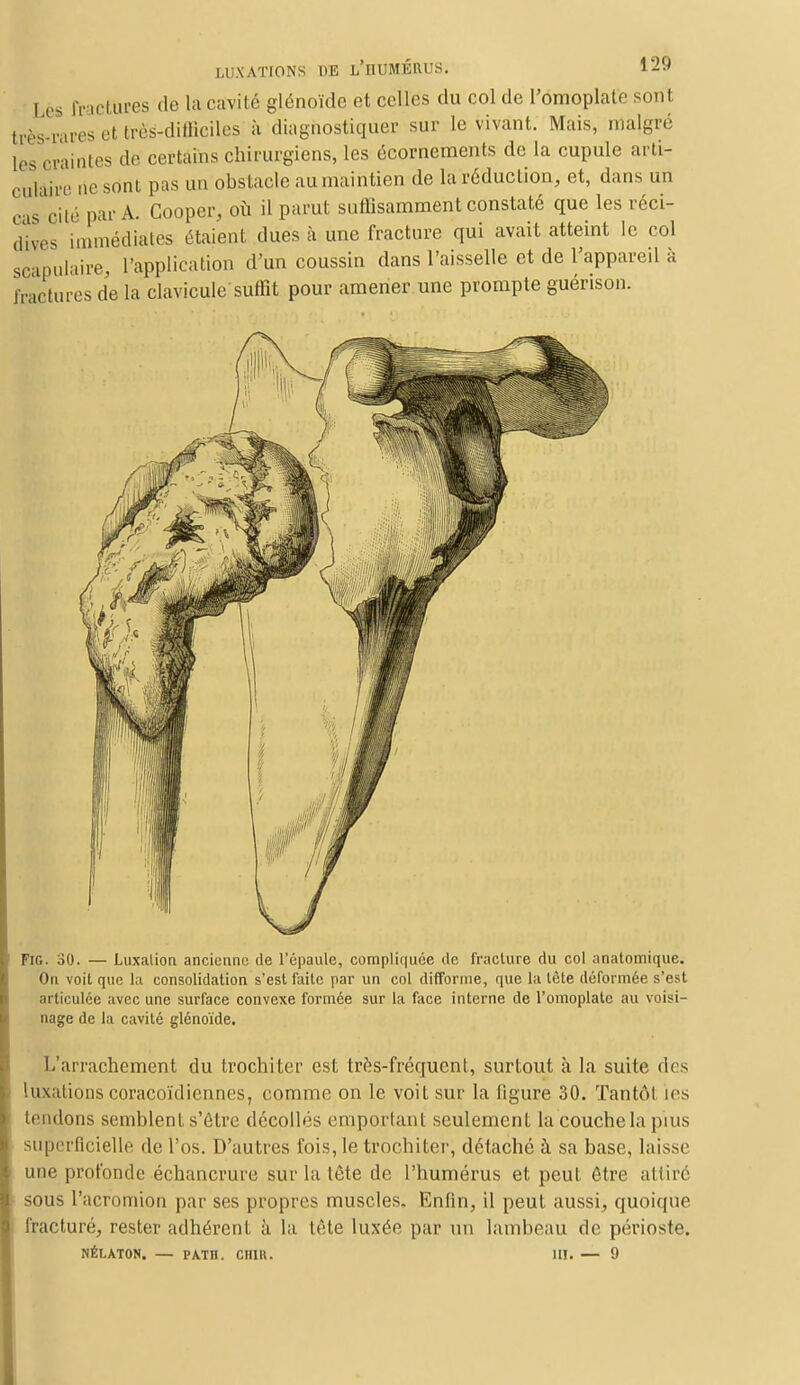1 ès fractures de la cavité glénoïde et celles du col de l'omoplate sont très-rares et très-difficiles à diagnostiquer sur le vivant. Mais, malgré [es craintes de certains chirurgiens, les écornements de la cupule arti- culaire ne sont pas un obstacle au maintien de la réduction, et, dans un cas cité par A. Cooper, où il parut suffisamment constaté que les réci- dives immédiates étaient dues à une fracture qui avait atteint le col scapulaire, l'application d'un coussin dans l'aisselle et de l'appareil à fractures de la clavicule suffit pour amener une prompte guérison. Fig. 30. — Luxation ancienne de l'épaule, compliquée de fracture du col anatomique. On voit que la consolidation s'est faite par un col difforme, que la tète déformée s'est articulée avec une surface convexe formée sur la face interne de l'omoplate au voisi- nage de la cavité glénoïde. L'arrachement du trochiter est très-fréquent, surtout à la suite des luxations coracoïdiennes, comme on le voit sur la figure 30. Tantôt les tendons semblent s'être décollés emportant seulement la couche la puis superficielle de l'os. D'autres fois, le trochiter, détaché à sa base, laisse une profonde échancrure sur la tète de l'humérus et peut être attiré sous l'acromion par ses propres muscles. Enfin, il peut aussi, quoique fracturé, rester adhérent à la tête luxée par un lambeau de périoste. NÉLATON. — PATH. CH1R. III. — 9