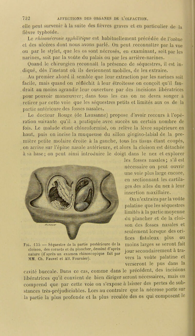 elle peut survenir à la suite des fièvres graves et en particulier d,e la fièvre typhoïde. Le rlrinonêcroslc syphilitique est habituellement précédée de l'ozène et des ulcères dont nous avons parlé. On peut reconnaître par la vue ou par le stylet, que les os sont nécrosés, en examinant, soit par les narines, soit par la voûte du palais ou par les arrière-narines. Quand le chirurgien reconnaît la présence de séquestres, il est in- diqué, dès l'instant où. ils deviennent mobiles, de les extraire. Au premier abord il semble que leur extraction par les narines soit facile, mais quand on réfléchit à leur élroitesse on conçoit qu'il fau- drait au moins agrandir leur ouverture par des incisions libératrices pour pouvoir manœuvrer; dans tous les cas on ne devra songer à retirer par cette voie que les séquestres petits et limités aux os de la partie antérieure des fosses nasales. Le docteur Rouge (de Lausanne) propose d'avoir recours à l'opé- ration suivante qu'il a pratiquée avec succès un certain nombre de fois. Le malade étant chloroformisé, on relève la lèvre supérieure en haut, puis on incise la muqueuse du sillon gingivo-labial de la pre- mière petite molaire droiLe à la gauche, tous les tissus étant coupés, on arrive sur l'épine nasale antérieure, et alors la cloison est détachée à sa base ; on peut ainsi introduire le doigt dans le nez et explorer les fosses nasales; s'il est nécessaire on peut ouvrir une voie plus large encore, en sectionnant les cartila- ges des ailes du nez à leur insertion maxillaire. On n'extraira par la voûte palatine que les séquestres limités à la partie moyenne du plancher et de la cloi- son des fosses nasales et seulement lorsque des ori- fices fistuleux plus ou moins larges se seront fait jour secondairement à tra- vers la voûte palatine et verseront le pus dans la cavité buccale. Dans ce cas, comme dans le précédent, des incisions libératrices qu'il convient de bien diriger seront nécessaires, mais on comprend que par cette voie on s'expose à laisser des pertes de sub- stances très-préjudiciables. Lors au contraire que la nécrose porte sur la partie la plus profonde et la plus reculée des os qui composent le Fjg. 135 — Séquestre de la partie postérieure de la cloison, des cornets et du plancher, dessiné d'après nature (d'après un examen rhinoscopiqne fait par MM. Ch. Fauvel et Ait. Fournier).