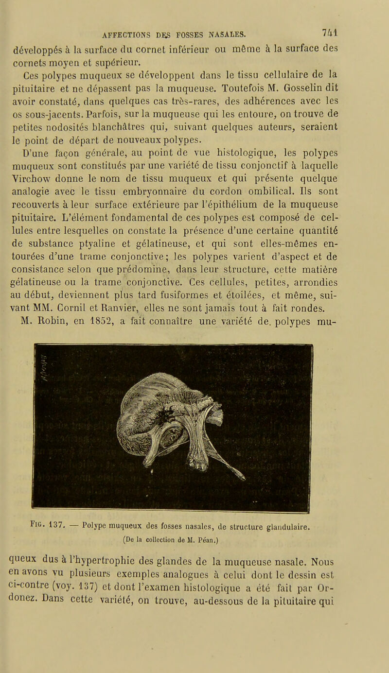 développés à la surface du cornet inférieur ou même à la surface des cornets moyen et supérieur. Ces polypes muqueux se développent dans le tissu cellulaire de la pituitaire et ne dépassent pas la muqueuse. Toutefois M. Gosselin dit avoir constaté, dans quelques cas tres-rares, des adhérences avec les os sous-jacents. Parfois, sur la muqueuse qui les entoure, on trouve de petites nodosités blanchâtres qui, suivant quelques auteurs, seraient le point de départ de nouveaux polypes. D'une façon générale, au point de vue histologique, les polypes muqueux sont constitués par une variété de tissu conjonctif à laquelle Yirchow donne le nom de tissu muqueux et qui présente quelque analogie avec le tissu embryonnaire du cordon ombilical. Ils sont recouverts à leur surface extérieure par l'épithélium de la muqueuse pituitaire. L'élément fondamental de ces polypes est composé de cel- lules entre lesquelles on constate la présence d'une certaine quantité de substance ptyaline et gélatineuse, et qui sont elles-mêmes en- tourées d'une trame conjonctive; les polypes varient d'aspect et de consistance selon que prédomine, dans leur structure, cette matière gélatineuse ou la trame conjonctive. Ces cellules, petites, arrondies au début, deviennent plus tard fusiformes et étoilées, et même, sui- vant MM. Cornil et Ranvier, elles ne sont jamais tout à fait rondes. M. Robin, en 1852, a fait connaître une variété de. polypes mu- Fic. 137. — Polype muqueux des fosses nasales, de structure glandulaire. (De la collection de M. Péan.) queux dus à l'hypertrophie des glandes de la muqueuse nasale. Nous en avons vu plusieurs exemples analogues à celui dont le dessin est ci-contre (voy. 137) et dont l'examen histologique a été fait par Or- donez. Dans cette variété, on trouve, au-dessous de la pituitaire qui