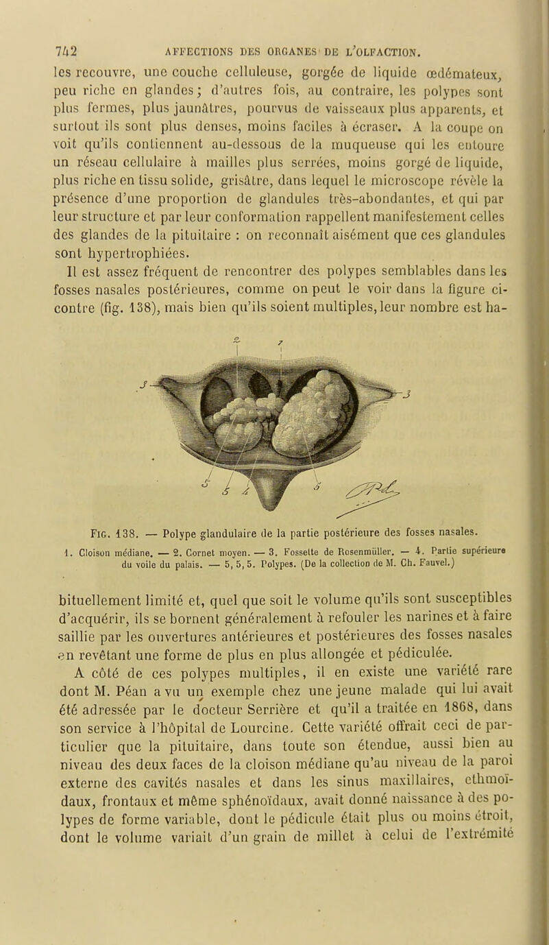 les recouvre, une couche celluleuse, gorgée de liquide œdémateux, peu riche en glandes; d'autres fois, au contraire, les polypes sont plus fermes, plus jaunâtres, pourvus de vaisseaux plus apparents, et surtout ils sont plus denses, moins faciles à écraser. A la coupe on voit qu'ils contiennent au-dessous de la muqueuse qui les entoure un réseau cellulaire à mailles plus serrées, moins gorgé de liquide, plus riche en tissu solide, grisâtre, dans lequel le microscope révèle la présence d'une proportion de glandules très-abondantes, et qui par leur structure et par leur conformation rappellent manifestement celles des glandes de la pituitaire : on reconnaît aisément que ces glandules sont hypertrophiées. Il est assez fréquent de rencontrer des polypes semblables dans les fosses nasales postérieures, comme on peut le voir dans la figure ci- contre (fig. 138), mais bien qu'ils soient multiples, leur nombre est ha- Fig. 138. — Polype glandulaire de la partie postérieure des fosses nasales. i. Cloison médiane. — 2. Cornet moyen. — 3. Fosselte de Rosenmuller. — i. Partie supérieure du voile du palais. — 5, 5, 5. Polypes. (De la collection de M. Ch. Fauvel.) bituellement limité et, quel que soit le volume qu'ils sont susceptibles d'acquérir, ils se bornent généralement à refouler les narines et à faire saillie par les ouvertures antérieures et postérieures des fosses nasales en revêtant une forme de plus en plus allongée et pédiculée. A côté de ces polypes multiples, il en existe une variété rare dont M. Péan a vu un exemple chez une jeune malade qui lui avait été adressée par le docteur Serrière et qu'il a traitée en 1868, dans son service à l'hôpital de Lourcine. Cette variété offrait ceci de par- ticulier que la pituitaire, dans toute son étendue, aussi bien au niveau des deux faces de la cloison médiane qu'au niveau de la paroi externe des cavités nasales et dans les sinus maxillaires, ethmoï- daux, frontaux et môme sphénoïdaux, avait donné naissance à des po- lypes de forme variable, dont le pédicule était plus ou moins étroit, dont le volume variait d'un grain de millet à celui de l'extrémité