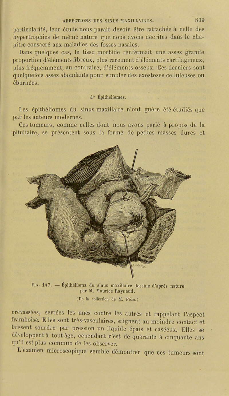 particularité, leur étude nous paraît devoir être rattachée à celle des hypertrophies de même nature que nous avons décrites dans le cha- pitre consacré aux maladies des fosses nasales. Dans quelques cas, le tissu morbide renfermait une assez grande proportion d'éléments fibreux, plus rarement d'éléments cartilagineux, plus fréquemment, au contraire, d'éléments osseux. Ces derniers sont quelquefois assez abondants pour simuler des exostoses celluleuses ou éburnées. 4° Ëpithéliomes. Les épithéliomes du sinus maxillaire n'ont guère été étudiés que par les auteurs modernes. Ces tumeurs, comme celles dont nous avons parlé à propos de la pifuitaire, se présentent sous la forme de petites masses dures et Fie. 147. — Épilhélioma du sinus maxillaire dessiné d'après nature par M. Maurice Raynaud. (De la collection de M. Péan.) crevassées, serrées les unes contre les autres et rappelant l'aspect framboisé. Elles sont très-vasculaires, saignent au moindre contact et laissent sourdre par pression un liquide épais et caséeux. Elles se développent à tout âge, cependant c'est de quarante à cinquante ans qu'il est plus commun de les observer. L'examen microscopique semble démontrer que ces tumeurs sont