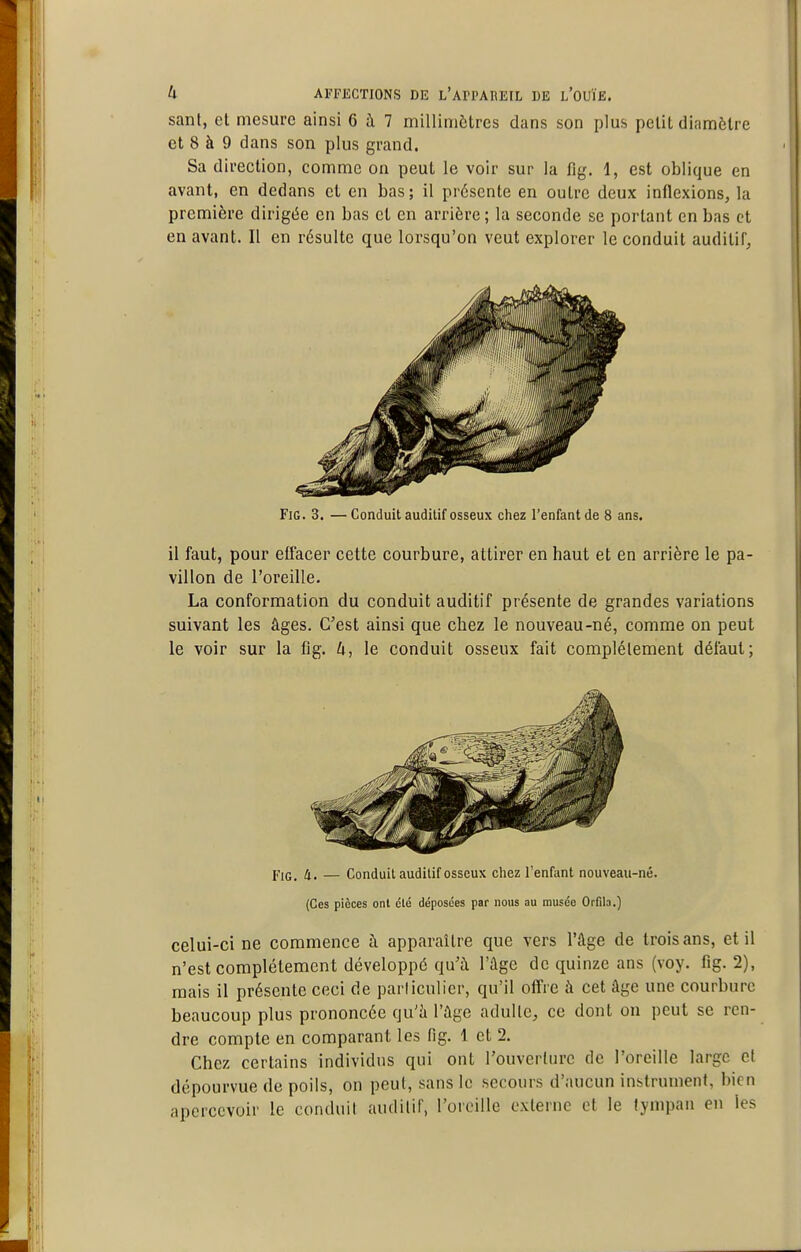sant, el mesure ainsi 6 à 7 millimètres dans son plus petit diamètre et 8 à 9 dans son plus grand. Sa direction, comme on peut le voir sur la fig. 1, est oblique en avant, en dedans et en bas ; il présente en outre deux inflexions, la première dirigée en bas et en arrière ; la seconde se portant en bas et en avant. Il en résulte que lorsqu'on veut explorer le conduit auditif, FiG. 3, — Conduit auditif osseux chez l'enfant de 8 ans. il faut, pour effacer cette courbure, attirer en haut et en arrière le pa- villon de l'oreille. La conformation du conduit auditif présente de grandes variations suivant les âges. C'est ainsi que chez le nouveau-né, comme on peut le voir sur la flg. U, le conduit osseux fait complélement défaut; PiQ_ 4. — Conduit auditif osseux chez l'enfant nouveau-né. (Ces pièces ont clé déposées par nous au musée Orfila.) celui-ci ne commence à apparaître que vers l'âge de trois ans, et il n'est complètement développé qu'à l'âge de quinze ans (voy. fig. 2), mais il présente ceci de particulier, qu'il offre à cet âge une courbure beaucoup plus prononcée qu'à l'âge adulte, ce dont on peut se ren- dre compte en comparant les fig. 1 et 2. Chez certains individus qui ont l'ouverture de l'oreille large cl dépourvue de poils, on peut, sans le secours d'aucun instrument, bien apercevoir le conduit audilif, l'oreille externe et le lynipan en les