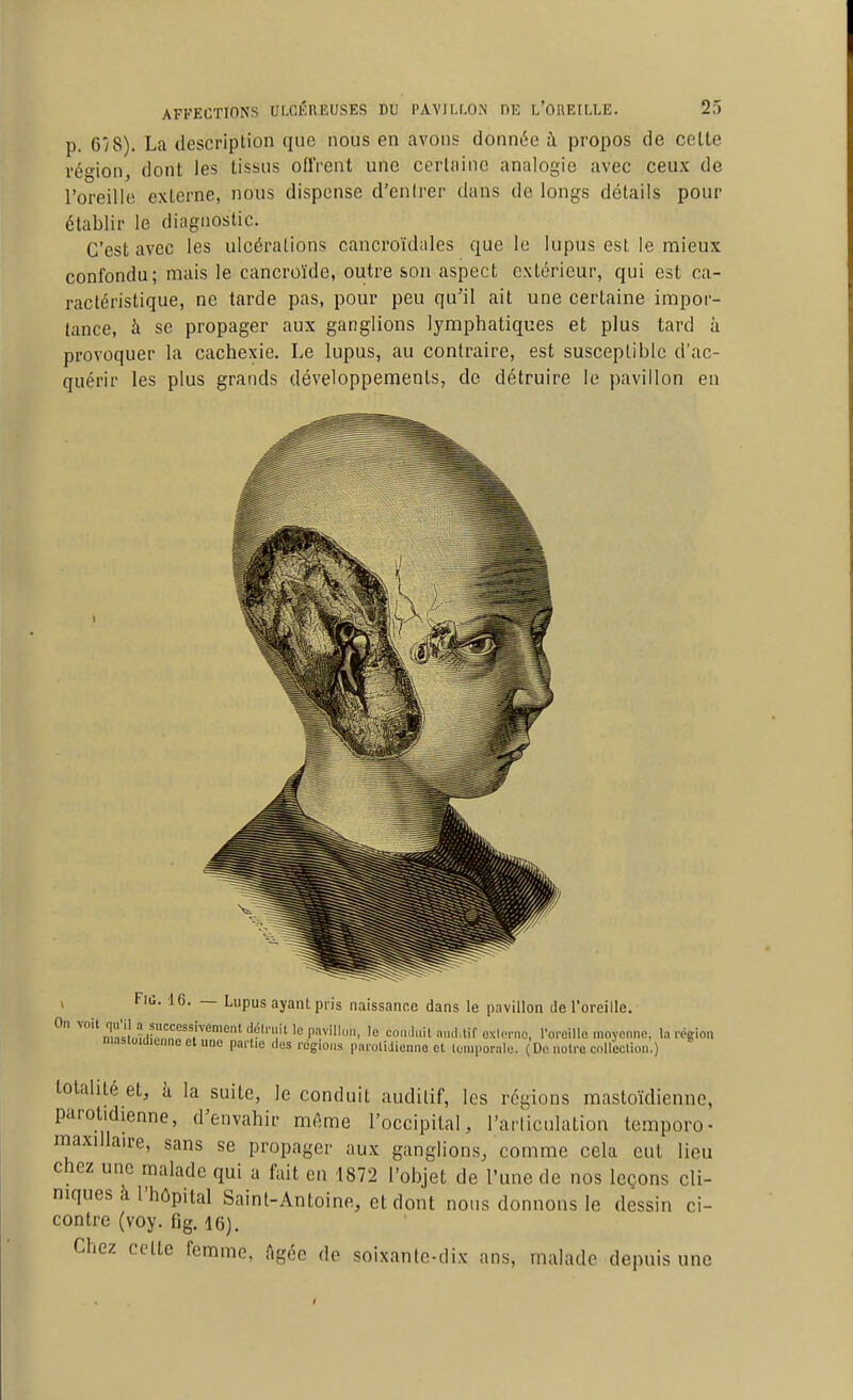 AFFECTIONS ULCÉREUSES DU PAVILLON DE L'OREILLE. 2:) p. 6y8). La descriplion que nous en avons donnée à propos de celle région, dont les tissus oflVent une cerlnino analogie avec ceux de l'oreille externe, nous dispense d'enirer dans de longs détails pour établir le diagnostic. C'est avec les ulcérations cancroïdales que le lupus est le mieux confondu; mais le cancroïde, outre son aspect extérieur, qui est ca- ractéristique, ne tarde pas, pour peu qu'il ait une certaine impor- tance, à se propager aux ganglions lymphatiques et plus tard à provoquer la cachexie. Le lupus, au contraire, est susceptible d'ac- quérir les plus grands développements, de détruire le pavillon en V FiG. 16. — Lupus ayant pris naissance dans le pavillon Je l'oreille. ° ''°'^TJL?HLn„'f t'^'''^ î?''''!''''^ P'^'' '0 coïKluit aud.tif exlorno, roi-oillo moyenne, la région mastuidienno et une partie des régions parolidienne et loniporale. (De noire cnlleclion.) totalité et, Ix la suite, le conduit auditif, les régions mastoïdienne, parotidienne, d'envahir même l'occipital, l'arliculation temporo- maxillaire, sans se propager aux ganglions, comme cela eut lieu chez une malade qui a fait en 1872 l'objet de l'une de nos leçons cli- niques à l'hôpital Saint-Antoine, et dont nous donnons le dessin ci- contre (voy. fîg. 16). Chez celte femme, Agée de soixante-dix ans, malade depuis une