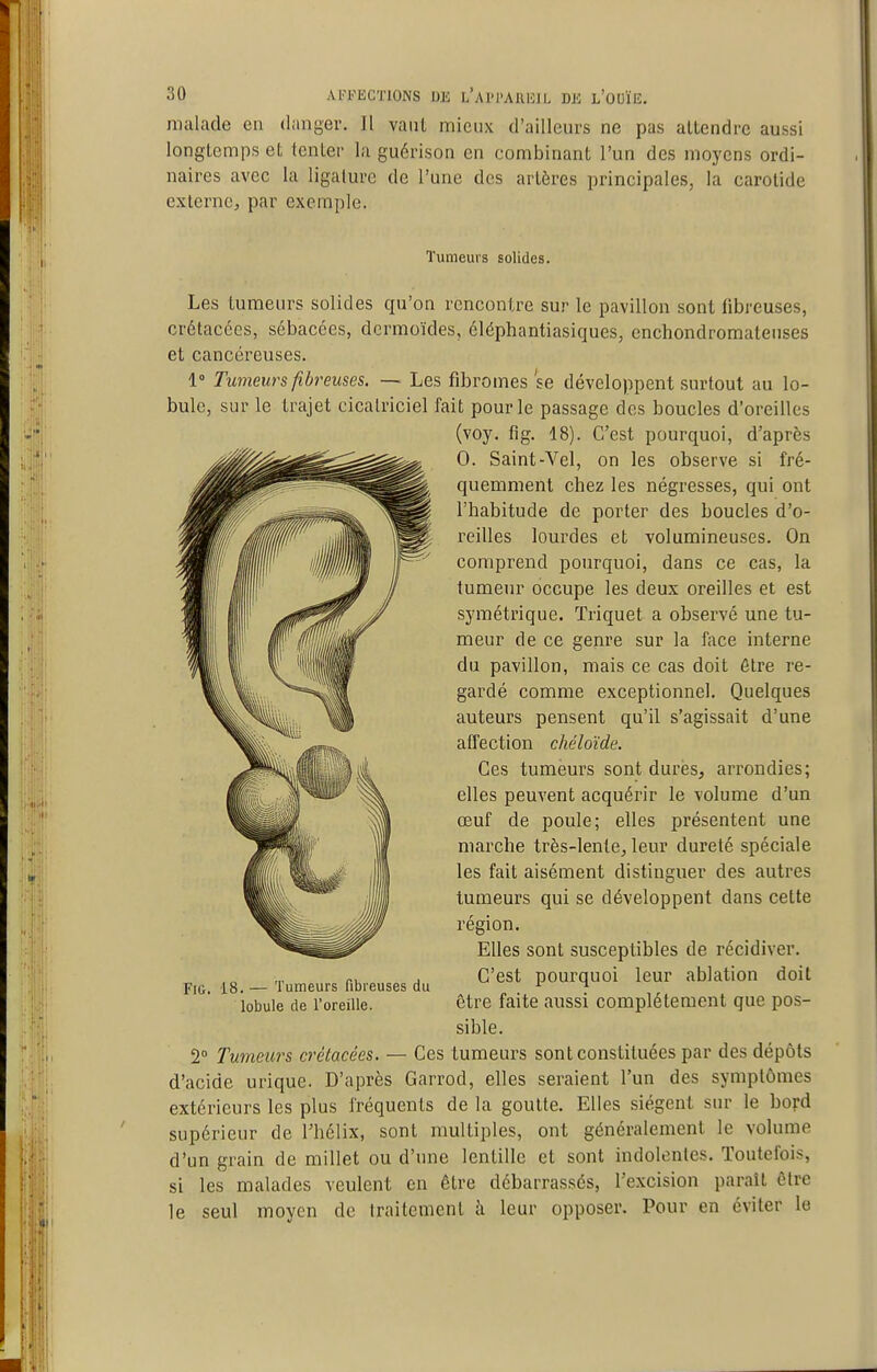 malade en danger. Il vaut mieux d'ailleurs ne pas attendre aussi longtemps et tenter la guérison en combinant l'un des moyens ordi- naires avec la ligature de l'une des artères principales, la carotide externe, par exemple. Tumeurs solides. Les tumeurs solides qu'on rencontre sur le pavillon sont fibreuses, crétacées, sébacées, dcrmoïdes, éléphantiasiques, enchondromatenses et cancéreuses. 1° Tumeurs fibreuses. — Les fibromes se développent surtout au lo- bule, sur le trajet cicatriciel fait pour le passage des boucles d'oreilles (voy. flg. 18). C'est pourquoi, d'après 0. Saint-Vel, on les observe si fré- quemment chez les négresses, qui ont l'habitude de porter des boucles d'o- reilles lourdes et volumineuses. On comprend pourquoi, dans ce cas, la tumeur occupe les deux oreilles et est symétrique. Triquet a observé une tu- meur de ce genre sur la face interne du pavillon, mais ce cas doit être re- gardé comme exceptionnel. Quelques auteurs pensent qu'il s'agissait d'une affection chéloïde. Ces tumeurs sont dures, arrondies; elles peuvent acquérir le volume d'un œuf de poule; elles présentent une marche très-lente, leur dureté spéciale les fait aisément distinguer des autres tumeurs qui se développent dans cette région. Elles sont susceptibles de récidiver. C'est pourquoi leur ablation doit être faite aussi complètement que pos- sible. 2° Tumeurs crétacées. — Ces tumeurs sont constituées par des dépôts d'acide urique. D'après Garrod, elles seraient l'un des symptômes extérieurs les plus fréquents de la goutte. Elles siègent sur le bofd supérieur de Thélix, sont multiples, ont généralement le volume d'un grain de millet ou d'une lentille et sont indolentes. Toutefois, si les malades veulent en être débarrassés, Texcision paraît être le seul moyen de traitement à leur opposer. Pour en éviter le FiG. 18. — Tumeurs fibreuses du lobule de l'oreille.