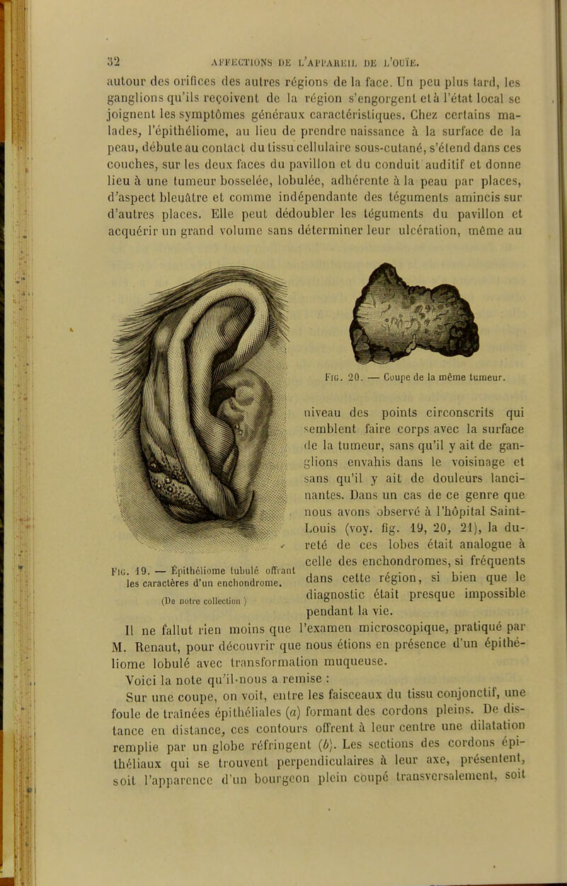 autour des orifices des aulres régions de la face. Un peu plus tard, les ganglions qu'ils reçoivent de la région s'engorgent et à l'état local se joignent les symptômes généraux caractéristiques. Chez certains ma- lades, l'épilhéliome, au lieu de prendre naissance à la surface de la peau, débute au contact du tissu cellulaire sous-cutané, s'étend dans ces couches, sur les deu.x faces du pavillon et du conduit auditif et donne lieu à une tumeur bosselée, lobulée, adhérente à la peau par places, d'aspect bleuâtre et comme indépendante des téguments amincis sur d'autres places. Elle peut dédoubler les téguments du pavillon et acquérir un grand volume sans déterminer leur ulcération, môme au FiG. 20. — Coupe de la même tumeur. niveau des points circonscrits qui semblent faire corps avec la surface (le la tumeur, sans qu'il y ait de gan- glions envahis dans le voisinage et sans qu'il y ait de douleurs lanci- nantes. Dans un cas de ce genre que nous avons observé à l'hôpital Saint- Louis (voy. flg. 19, 20, 21), la du- reté de ces lobes était analogue à celle des enchondromes, si fréquents dans cette région, si bien que le diagnostic était presque impossible pendant la vie. Il ne fallut rien moins que l'examen microscopique, pratiqué par M. Renaut, pour découvrir que nous étions en présence d'un épithé- liome lobulé avec transformation muqueuse. Voici la note qu'il-nous a remise : Sur une coupe, on voit, entre les faisceaux du tissu conjonctif, une foule de traînées épithcliales (a) formant des cordons pleins. De dis- tance en distance, ces contours oflVent à leur centre une dilatation remplie par un globe réfringent {b). Les sections des cordons épi- théliaux qui se trouvent perpendiculaires à leur axe, présentent, soit l'apparence d'un bourgeon plein coupé transversalement, soit FiG. 19. — Épilhéliome tubulé oPFranl les caractères d'un enciiondrome. (De notre colleclion )