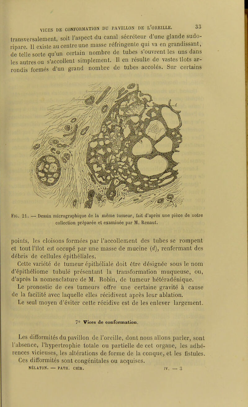 transversalement, soit l'aspect du canal sécréteur d'une glande sudo- ripare. 11 existe au centre une masse réfringente qui va en grandissant, de telle sorte qu'un certain nombre de tubes s'ouvrent les uns dans les autres ou s'accoUent simplement. 11 en résulte de vastes îlots ar- rondis formés d'un grand nombre de tubes accolés. Sur certains FiG. 21. — Dessin micrographique de la même tumeur, fait d'après une pièce de notre collection préparée et examinée par M. Renaut. points, les cloisons formées par l'accoUement des tubes se rompent et tout l'îlot est occupé par une masse de mucine {d), renfermant des débris de cellules épithéliales. Cette variété de tumeur épitbélialé doit être désignée sous le nom d'épithéliome tabulé présentant la transformation muqueuse, ou, d'après la nomenclature de M. Robin, de tumeur hétéradénique. Le pronostic de ces tumeurs offre une certaine gravité à cause de la facilité avec laquelle elles récidivent après leur ablation. Le seul moyen d'éviter celte récidive est de les enlever largement. 7° Vices de conformation. Les difformités du pavillon de l'oreille, dont nous allons parler, sont l'absence, l'hypertrophie totale ou partielle de cet organe, les adhé- rences vicieuses, les altérations de forme de la conque, et les fistules. Ces difformités sont congénitales ou acquises. NÉLATON. — PATH. CHlR. IV. — ;!