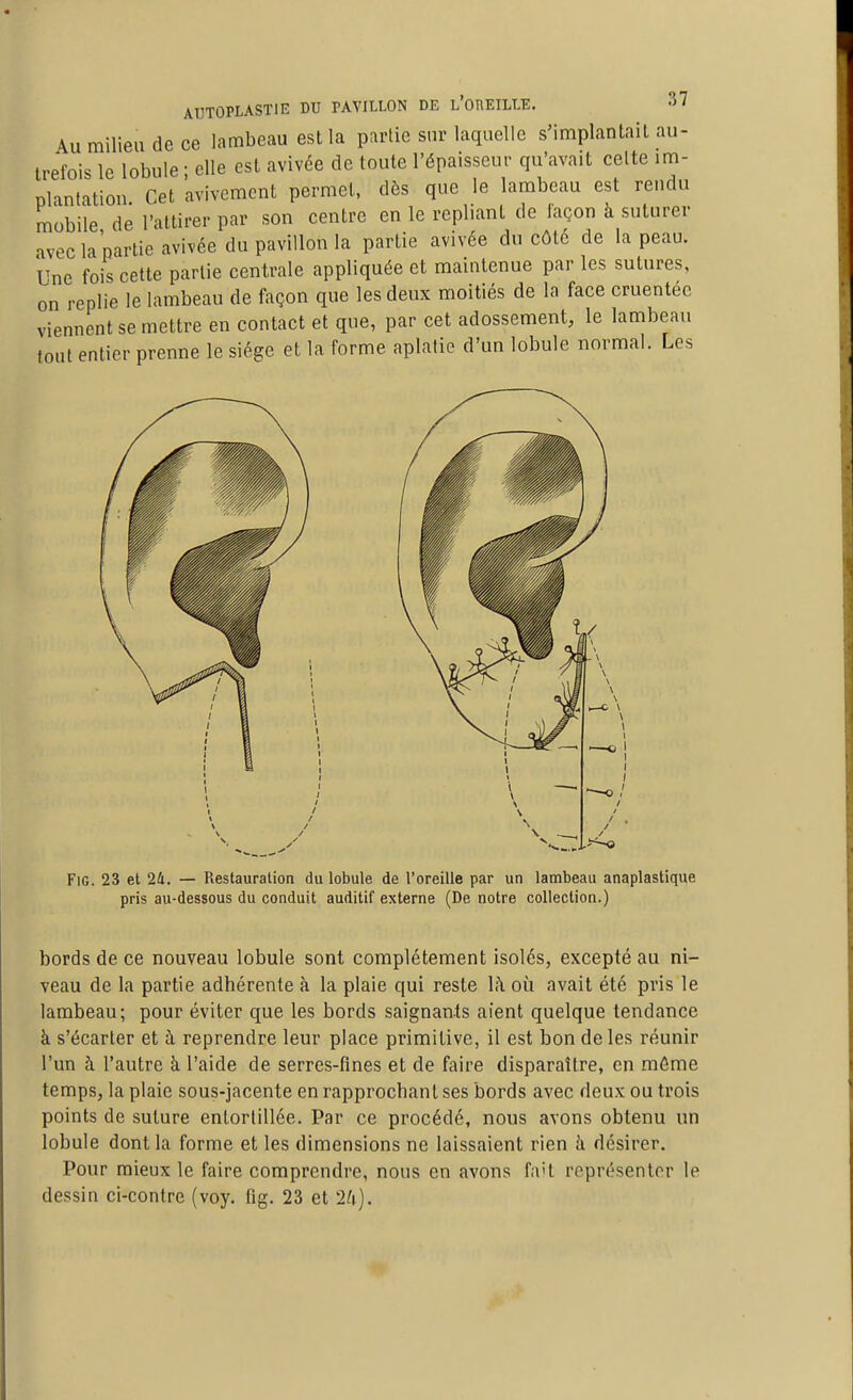 AUTOPLASTIE DU PAVILLON DE l'oUEILLE. -57 Au milieu de ce lambeau est la partie sur laquelle s'implantait au- trefois le lobule ; elle est avivée de toute l'épaisseur qu'avait celte im- plantation Cet avivcment permet, dès que le lambeau est rendu mobile de l'attirer par son centre en le repliant de façon à suturer avec la partie avivée du pavillon la partie avivée du côté de la peau. Une fois cette partie centrale appliquée et maintenue par les sutures, on replie le lambeau de façon que les deux moitiés de la face cruentéc viennent se mettre en contact et que, par cet adossement, le lambeau tout entier prenne le siège et la forme aplatie d'un lobule normal. Les FiG. 23 et 24. — Restauration du lobule de l'oreille par un lambeau anaplastique pris au-dessous du conduit auditif externe (De notre collection.) bords de ce nouveau lobule sont complètement isolés, excepté au ni- veau de la partie adhérente à la plaie qui reste \k où avait été pris le lambeau; pour éviter que les bords saignants aient quelque tendance à s'écarter et à reprendre leur place primitive, il est bon de les réunir l'un à l'autre à l'aide de serres-fines et de faire disparaître, en môme temps, la plaie sous-jacente en rapprochant ses bords avec deux ou trois points de suture entortillée. Par ce procédé, nous avons obtenu un lobule dont la forme et les dimensions ne laissaient rien à désirer. Pour mieux le faire comprendre, nous en avons fa't représenter le dessin ci-contre (voy. fig. 23 et 2/i).