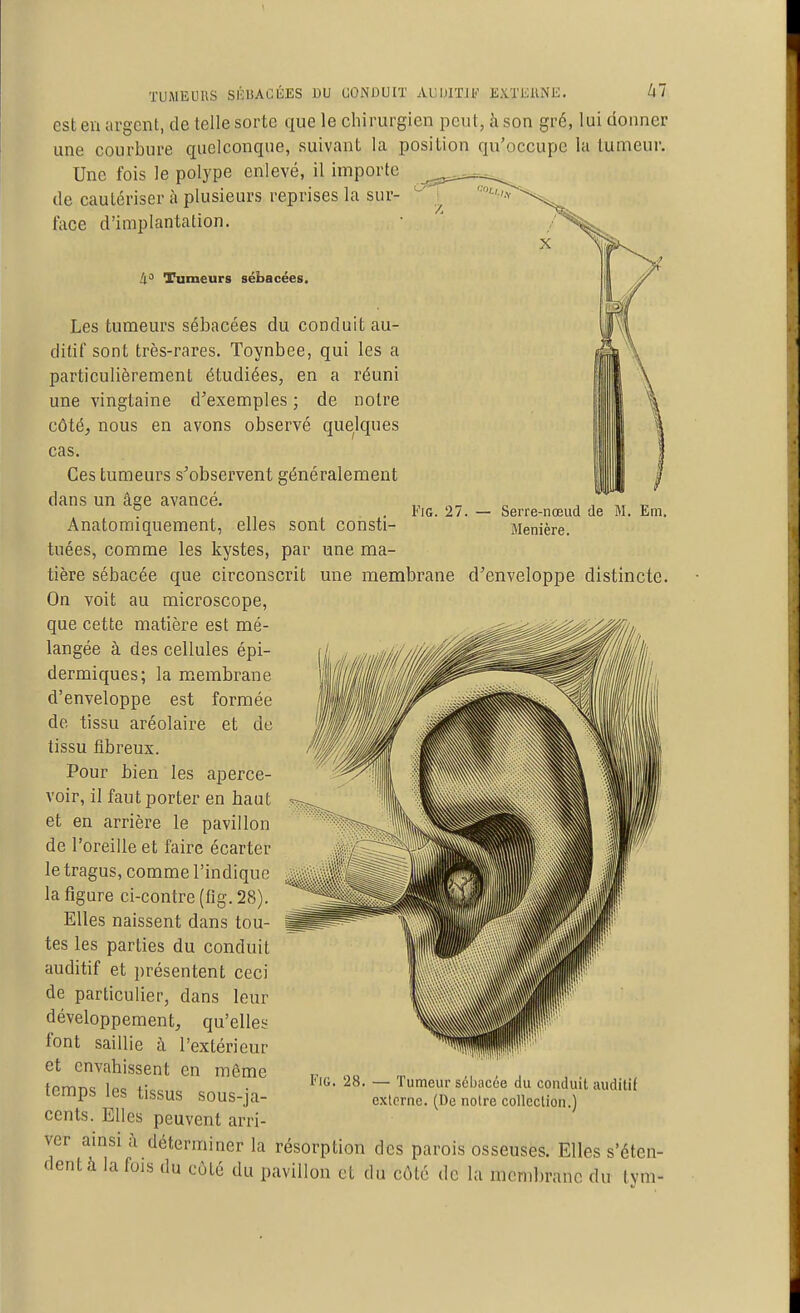 FiG. 27. — Serre-nœud de M. Em, Menière. TUiMEUUS SÉliACÈES BU CONDUIT AUIJIÏIF EXTlillNE. est en argent, de telle sorte que le chirurgien peut, à son gré, lui donner une courbure quelconque, suivant la position qu'occupe la tumeur. Une fois le polype enlevé, il importe de cautériser à plusieurs reprises la sur- face d'implantation. h Tumeurs sébacées. Les tumeurs sébacées du conduit au- ditif sont très-rares. Toynbee, qui les a particulièrement étudiées, en a réuni une vingtaine d'exemples ; de notre côté, nous en avons observé quelques cas. Ces tumeurs s'observent généralement dans un âge avancé. Anatomiquement, elles sont consti- tuées, comme les kystes, par une ma- tière sébacée que circonscrit une membrane d'enveloppe distincte On voit au microscope, que cette matière est mé- langée à des cellules épi- dermiques; la membrane d'enveloppe est formée de tissu aréolaire et de tissu fibreux. Pour bien les aperce- voir, il faut porter en haut et en arrière le pavillon de l'oreille et faire écarter le tragus, comme l'indique la figure ci-contre (flg. 28). Elles naissent dans tou- tes les parties du conduit auditif et présentent ceci de particulier, dans leur développement, qu'elles font saillie à l'extérieur et envahissent en môme temps les tissus sous-ja- cents. Elles peuvent arri- ver amsi à déterminer la résorption des parois osseuses. Elles s'éten- dent à la fois du côté du pavillon et du côte de la membrane du lym- FiG. 28. — Tumeur sébacée du conduit auditif externe. (De notre collection.)