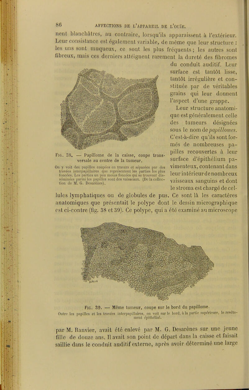 0^ ''A I 86 AFFECTIONS DE L'APPAREIL DE l/OUÏE. nent blancliAtres, au contraire, lorsqu'ils apparaissent à Texlérieur. Leur consistance est également variable, de môme que leur structure : les uns sont muqueux, ce sont les plus fréquents; les autres sont fibreux, mais ces derniers atteignent rarement la dureté des fibromes du conduit auditif. Leur surface est tantôt lisse, ^#%f?-;iïV7fi,<?;#Qf>|^' tantôt irrégulière et con- stituée par de véritables grains qui leur donnent l'aspect d'une grappe. Leur structure anatomi- quc est généralement celle des tumeurs désignées sous le nom de papillomes. C'est-à-dire qu'ils sont for- més de nombreuses pa- pilles recouvertes à leur surface d'épithélium pa- vimenteux, contenant dans leur intérieur denombreux vaisseaux sanguins et dont le stroma est chargé de cel- lules lymphatiques ou de globules de pus. Ce sont là les caractères anatomiques que présentait le polype dont le dessin micrographique est ci-contre (fig. 38 et 39). Ce polype, qui a été e.Kaminé au microscope FiG. 38. — Papillome de la caisse, coupe trans- versale au centre de la tumeur. On y voit des papilles coiipcps en Iravers et séparées par clos travées interpapillaires qnc représentent les parties les pins l'oncces. Les parties un pou moins foncées qui se trouvent dis- séminées parmi les papilles sont tics vaisseaux. (Do la collec- tion do M. G. Dosarènes). FiG. 39. — Même tumeur, coupe sur le bord du papillome. Ouiro les papilles et les travées interpapillaires, on voit sur le bord, à la partie supérionro, le revête- ment épitliélial. par M. Ranvier, avait été enlevé par M. G. Desarènes sur une jeune fille de douze ans. Il avait son point de départ dans la caisse et faisait saillie dans le conduit auditif externe, après avoir déterminé une large