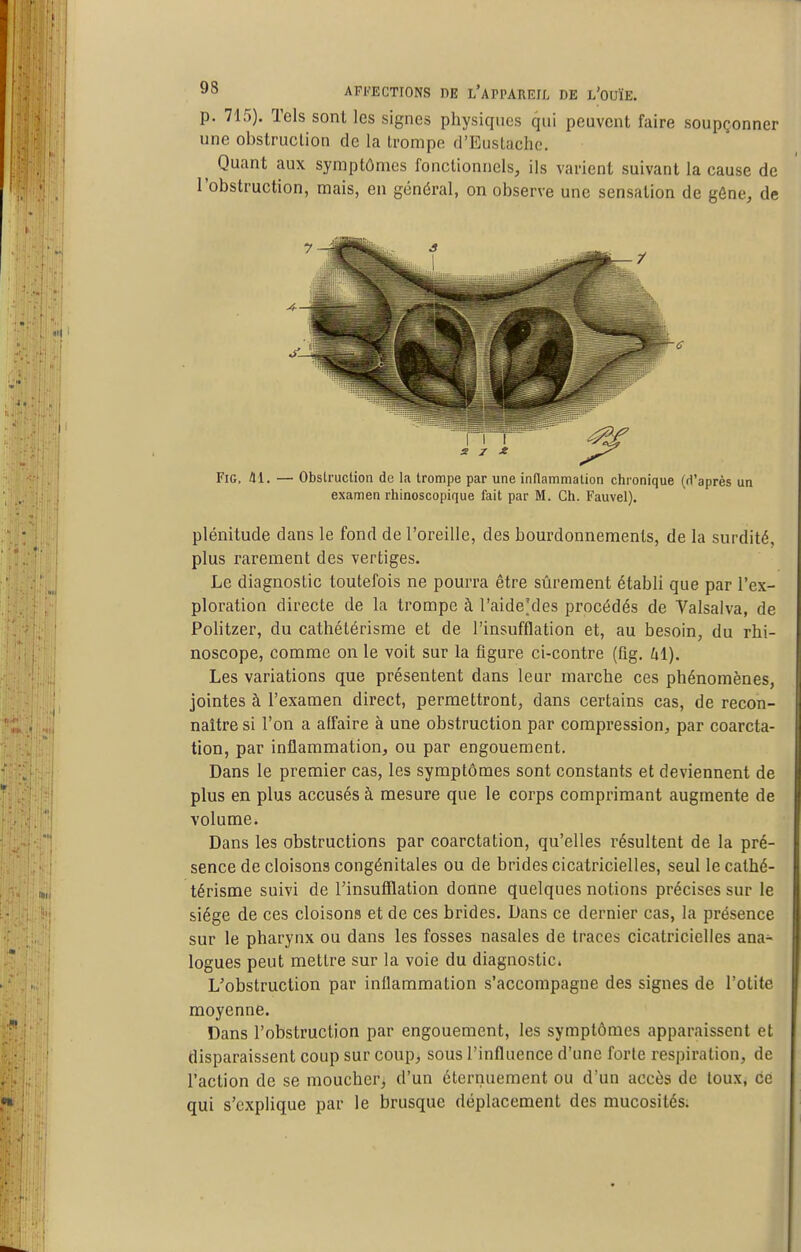 p. 715). Tels sont les signes physiques qui peuvent faire soupçonner une obstruction de la trompe d'EusLache. ^ Quant aux symptômes fonctionnels, ils varient suivant la cause de l'obstruction, mais, en général, on observe une sensation de gêne, de FiG. 41. — Obslruction de la trompe par une inflammation chronique (d'après un examen rhinoscopique fait par M. Ch. Fauvel). plénitude dans le fond de l'oreille, des bourdonnements, de la surdité, plus rarement des vertiges. Le diagnostic toutefois ne pourra être stirement établi que par l'ex- ploration directe de la trompe à l'aide'des procédés de Valsalva, de Politzer, du cathétérisme et de l'insufflation et, au besoin, du rhi- noscope, comme on le voit sur la figure ci-contre (fig. Ul). Les variations que présentent dans leur marche ces phénomènes, jointes à l'examen direct, permettront, dans certains cas, de recon- naître si l'on a affaire à une obstruction par compression, par coarcta- tion, par inflammation, ou par engouement. Dans le premier cas, les symptômes sont constants et deviennent de plus en plus accusés à mesure que le corps comprimant augmente de volume. Dans les obstructions par coarctation, qu'elles résultent de la pré- sence de cloisons congénitales ou de brides cicatricielles, seul le cathé- térisme suivi de l'insufflation donne quelques notions précises sur le siège de ces cloisons et de ces brides. Dans ce dernier cas, la présence sur le pharynx ou dans les fosses nasales de traces cicatricielles ana- logues peut mettre sur la voie du diagnostic. L'obstruction par inflammation s'accompagne des signes de l'otite moyenne. Dans l'obstruction par engouement, les symptômes apparaissent et disparaissent coup sur coup, sous l'influence d'une forte respiration, de l'action de se moucher, d'un éternuement ou d'un accès de toux, ce qui s'explique par le brusque déplacement des mucosités.