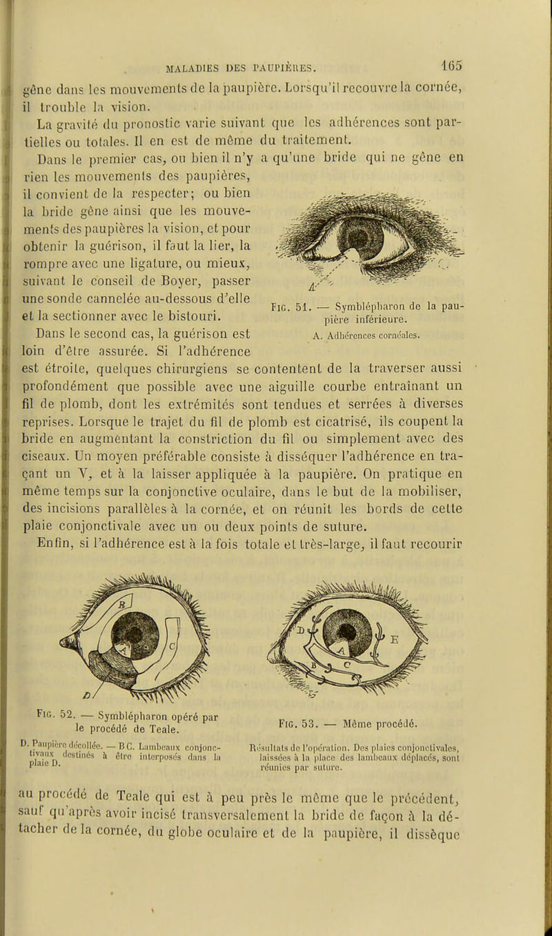 génc dans les mouvements de la paupière. Lorsqu'il recouvre la cornée, il trouble la vision. La gravité du pronostic varie suivant que les adhérences sont par- tielles ou totales. Il en est de môme du traitement. Dans le premier cas, ou bien il n'y a qu'une bride qui ne gène en rien les mouvements des paupières, il convient de la respecter; ou bien la bride gêne ainsi que les mouve- ments des paupières la vision, et pour obtenir la guérison, il faut la lier, la rompre avec une ligature, ou mieux, suivant le conseil de Boyer, passer une sonde cannelée au-dessous d'elle et la sectionner avec le bistouri. Dans le second cas, la guérison est loin d'être assurée. Si l'adhérence est étroite, quelques chirurgiens se contentent de la traverser aussi profondément que possible avec une aiguille courbe entraînant un fil de plomb, dont les extrémités sont tendues et serrées à diverses reprises. Lorsque le trajet du fd de plomb est cicatrisé, ils coupent la bride en augmentant la constriction du fd ou simplement avec des ciseaux. Un moyen préférable consiste à disséquer l'adhérence en tra- çant un V, et à la laisser appliquée à la paupière. On pratique en même temps sur la conjonctive oculaire, dans le but de la mobiliser, des incisions parallèles à la cornée, et on réunit les bords de celte plaie conjonctivale avec un ou deux points de suture. Enfin, si l'adhérence est à la fois totale et très-large, il faut recourir FiG. 51. — Symblépliaron de la pau- pière inférieure. A. Adlic'rences corncalcs. FiG. 52. — Symblépharon opéré par „ , ,, le procédé de Teale.  ^^^^ P'''^^^^- D. Paupière diîcolliîe. — B C. Lumboaiix conjonc- Riisnllals de l'opdration. Des plaies conjonclivalcs, tivaiix tlcslincs à éire interposas flans la laissées à la place des lambeaux ddplacds, soiil P ^ réunies par suUn'e. au procédé de Teale qui est ;\ peu près le môme que le précédent, sauf qu'après avoir incisé transversalement la bride de façon i\ la dé- tacher delà cornée, du globe oculaire et de la paupière, il dissèque