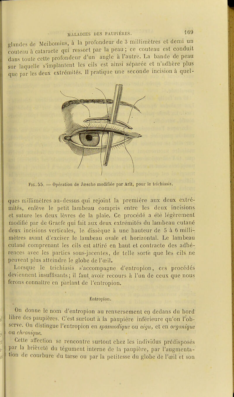 glandes do Meiboniius, h la profondeur de 3 milliinèti-es et demi un couteau îi calaracle qui ressort par la peau; ce couteau est conduit dans toute cette profondeur d'un angle h l'autre. La bande de peau sur laquelle s'implanlent les cils est ainsi séparée et n'adhère plus aue par les deux extrémités. Il pratique une seconde incision à quel- FiG.55. —Opération de Jœsclie modifiée par Arlt, pour le tiicliiasis. ques millimètres au-dessus qui rejoint la première aux deux extré- mités, enlève le petit lambeau compris entre les deux incisions et suture les deux lèvres de la plaie. Ce procédé a été légèrement modifié par de Graefe qui fait aux deux extrémités du lambeau cutané deux incisions verticales, le dissèque à une hauteur de 5 à 6 milli- mètres avant d'exciser le lambeau ovale et horizontal. Le lambeau cutané comprenant les cils est attiré en haut et contracte des adhé- rences avec les parties sous-jnccnles, de telle sorte que les cils ne peuvent plus atteindre le globe de l'œil. Loi'sque le trichiasis s'accompagne d'entropion, ces pi'océdés deviennent insuffisants; il faut, avoir recours à l'un de ceux que nous ferons connaître en parlant de l'enlropion. Entropion. On donne le nom d'entropion au renversement en dedans du bord libre des paupières. C'est surtout à la paupière inférieure qu'on l'ob- serve. On distingue l'entropion en spasmodique ou aigu, et en organique ou chronique. Cette aflection se rencontre surtout chez les individus prédisposés par la brièveté du tégument interne de la paupière, par l'augmenta- tion de courbure du tarse ou par la petitesse du globe de Toeil et son