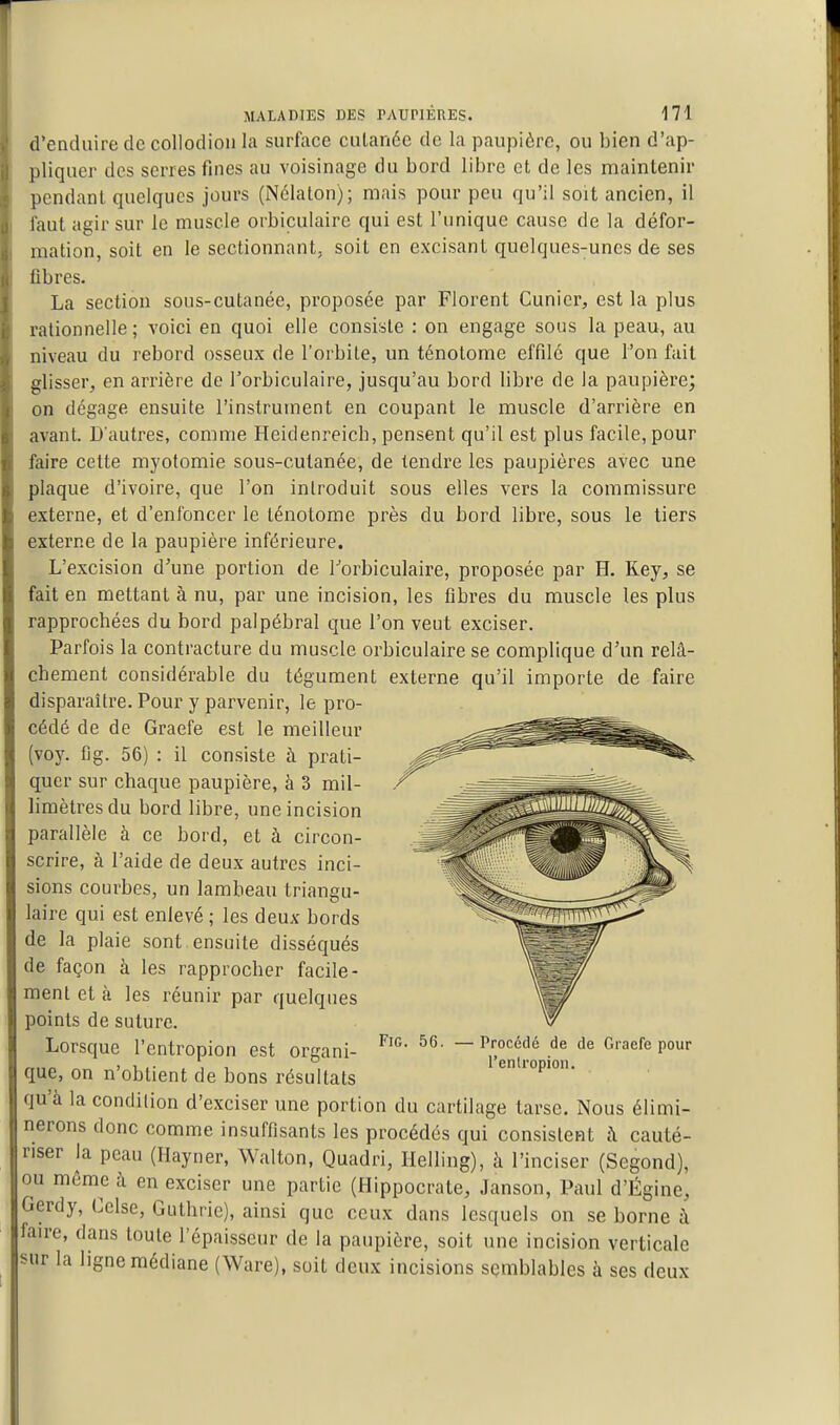 d'enduire de collodioii la surface cutanée de la paupière, ou bien d'ap- pliquer des serres fines au voisinage du bord libre et de les maintenir pendant quelques jours (Nélalon); mais pour peu qu'il soit ancien, il faut agir sur le muscle orbiculaire qui est l'unique cause de la défor- mation, soit en le sectionnant, soit en excisant quelques-unes de ses libres. La section sous-cutanée, proposée par Florent Cunier, est la plus rationnelle; voici en quoi elle consiste : on engage sous la peau, au niveau du rebord osseux de l'orbite, un ténotome effilé que l'on fait glisser, en arrière de l'orbiculaire, jusqu'au bord libre de la paupière; on dégage ensuite l'instrument en coupant le muscle d'arrière en avant. D'autres, comme Heidenreicb, pensent qu'il est plus facile, pour faire cette myotomie sous-cutanée, de tendre les paupières avec une plaque d'ivoire, que l'on introduit sous elles vers la commissure externe, et d'enfoncer le ténotome près du bord libre, sous le tiers externe de la paupière inférieure. L'excision d'une portion de Torbiculaire, proposée par H. Key, se fait en mettant à nu, par une incision, les fibres du muscle les plus rapprochées du bord palpébral que l'on veut exciser. Parfois la contracture du muscle orbiculaire se complique d'un relâ- chement considérable du tégument externe qu'il importe de faire disparaître. Pour y parvenir, le pro- cédé de de Graefe est le meilleur (voy. flg. 56) : il consiste à prati- quer sur chaque paupière, à 3 mil- limètres du bord libre, une incision parallèle à ce bord, et à circon- scrire, à l'aide de deux autres inci- FiG. 56. Procédé de de Graefe pour l'entropion. sions courbes, un lambeau triangu- laire qui est enlevé ; les deux bords de la plaie sont ensuite disséqués de façon à les rapprocher facile- ment et à les réunir par quelques points de suture. Lorsque l'entropion est organi- que, on n'obtient de bons résultats qu'à la condition d'exciser une portion du cartilage tarse. Nous élimi- nerons donc comme insuffisants les procédés qui consistent à cauté- riser la peau (Hayner, Walton, Quadri, Ilelling), à l'inciser (Segond), ou même à en exciser une partie (Hippocrate, Janson, Paul d'Égine, Gerdy, Celse, Guthrie), ainsi que ceux dans lesquels on se borne à faire, dans toute l'épaisseur de la paupière, soit une incision verticale sur la ligne médiane (Ware), soit deux incisions semblables à ses deux