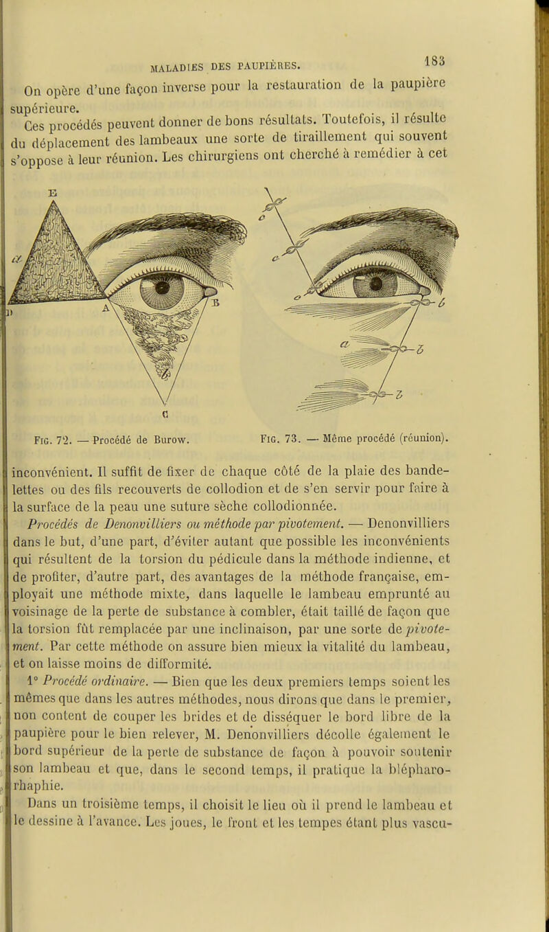 On opère d'une façon inverse pour la restauration de la paupière supérieure. ^ ■ ^^ t Ces procédés peuvent donner de bons résultats. Toutefois, il résulte du déplacement des lambeaux une sorte de tiraillement qui souvent s'oppose à leur réunion. Les chirurgiens ont cherché à remédier à cet FiG. 7'2. — Procédé de Burow. FiG. 73. — Même procédé (réunion). inconvénient. Il suffit de fixer de chaque côté de la plaie des bande- lettes ou des fils recouverts de collodion et de s'en servir pour faire à la surface de la peau une suture sèche coUodionnée. Procédés de Denonvilliers ou méthode par' pivotement. — Denonvilliers dans le but, d'une part, d'éviter autant que possible les inconvénients qui résultent de la torsion du pédicule dans la méthode indienne, et de profiter, d'autre part, des avantages de la méthode française, em- ployait une méthode mixte, dans laquelle le lambeau emprunté au voisinage de la perte de substance à combler, était taillé de façon que la torsion fût remplacée par une inclinaison, par une sorte pivote- ment. Par cette méthode on assure bien mieux la vitalité du lambeau, et on laisse moins de difformité. 1° Procédé ordinaire. — Bien que les deux premiers temps soient les mêmes que dans les autres méthodes, nous dirons que dans le premier, non content de couper les brides et de disséquer le bord libre de la paupière pour le bien relever, M. Denonvilliers décolle également le bord supérieur de la perle de substance de façon à pouvoir soutenir son lambeau et que, dans le second temps, il pratique la blépharo- rhaphie. Dans un troisième temps, il choisit le lieu oîi il prend le lambeau et le dessine à l'avance. Les joues, le front et les tempes étant plus vascu-