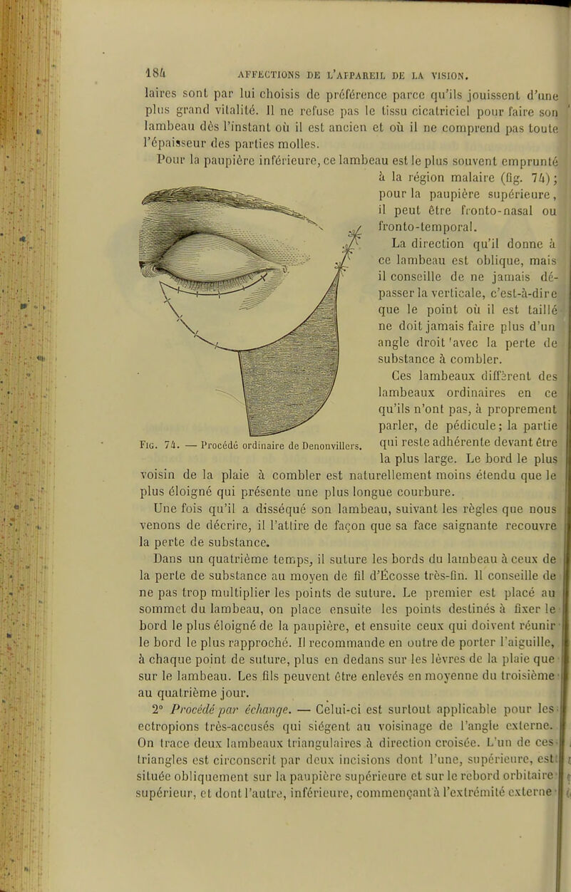 laires sont par lui choisis de préférence parce qu'ils jouissent d'uDe plus grand vitalité. 11 ne refuse pas le tissu cicatriciel pour faire sou lambeau dès l'instant où il est ancien et où il ne comprend pas toute l'épaisseur des parties molles. Pour la paupière inférieure, ce lambeau est le plus souvent emprunté FiG. 74. — Procédé ordi naire de DenonviUers. q' ieste adhérente devant être la plus large. Le bord le plus voisin de la plaie h combler est naturellement moins étendu que le plus éloigné qui présente une plus longue courbure. Une fois qu'il a disséqué son lambeau, suivant les règles que nous venons de décrire, il l'atlire de façon que sa face saignante recouvre la perte de substance. Dans un quatrième temps, il suture les bords du lambeau à ceux de: la perte de substance au moyen de fil d'Écosse très-Gn. 11 conseille de : ne pas trop multiplier les points de suture. Le premier est placé au sommet du lambeau, on place ensuite les points destinés à fixer le' bord le plus éloigné de la paupière, et ensuite ceux qui doivent réunif- ie bord le plus rapproché. Il recommande en outre de porter l'aiguille, à chaque point de suture, plus en dedans sur les lèvres de la plaie que sur le lambeau. Les fils peuvent être enlevés en moyenne du troisième' au quatrième jour. 2° Procédépa?' échange. — Celui-ci est surtout applicable pour les; ectropions très-accusés qui siègent an voisinage de l'angle cxlerne. On trace deux lambeaux triangulaires à direction croisée. L'un de ces- triangles est circonscrit par deux incisions dont l'une, supérieure, est: située obliquement sur la paupière supérieure et sur le rebord orbitaire supérieur, et dont l'autre, inférieure, commençantà l'extrémité externe h la région malaire (fig. lli); pour la paupière supérieure , il peut être fionto-nasal ou fronto-temporal. La direction qu'il donne à ce lambeau est oblique, mais il conseille de ne jamais dé- passer la verticale, c'est-à-dire que le point où il est taillé ne doit jamais faire plus d'un angle droit 'avec la perte de substance à combler. Ces lambeaux diffèrent des lambeaux ordinaires en ce qu'ils n'ont pas, à proprement parler, de pédicule; la partie