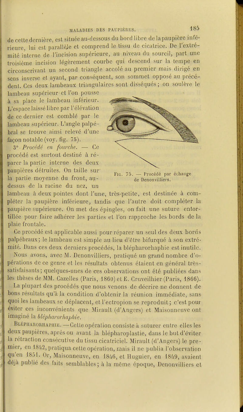 FiG. 75. — Procédé par échange de Denonvilliers. MALADIES DES PAUPIÈRES. de celle dernière, est située au-dessous du bord libre de la paupière infé- rieure lui est parallôje el comprend le tissu de cicatrice. De l'exlré- mité interne de l'incision supérieure, au niveau du sourcil, part une troisième incision légèrement courbe qui descend sur la tempe en circonscrivant un second triangle accolé au premier mais dirigé en sens inverse et ayant, par conséquent, son sommet opposé au précé- dent. Ces deux lambeaux triangulaires sont disséqués ; on soulève le lambeau supérieur et l'on pousse à sa place le lambeau inférieur. L'espace laissé libre par l'élévation de ce dernier est comblé par le lambeau supérieur. L'angle palpé- bral se trouve ainsi relevé d'une façon notable (voy. fig. 75). 3° Procédé en fourche. — Ce procédé est surtout destiné à ré- parer la partie interne des deux paupières détruites. On taille sur' la partie moyenne du front, au- dessus de la racine du nez, un lambeau h deux pointes dont Tune, très-petite, est destinée à com- pléter la paupière inférieure, tandis que l'autre doit compléter lu paupière supérieure. On met des épingles, on fait une suture entor- tillée pour faire adhérer les parties et l'on rapproche les bords de la plaie frontale. Ce procédé est applicable aussi pour réparer un seul des deux bords palpébraux; le lambeau est simple au lieu d'être bifurqué à son extré- mité. Dans ces deux derniers procédés, la blépharorhaphie est inutile. Nous avons, avec M. Denonvilliers, pratiqué im grand nombre d'o- pérations de ce genre et les résultats obtenus étaient en général très- satisfaisants; quelques-unes de ces observations ont été publiées dans les thèses de MM. Gazelles (Paris, 1860) el E. Gruveilhier (Paris, 1866). La plupart des procédés que nous venons de décrire ne donnent de bons résultats qu'à la condition d'obtenir la réunion immédiate, sans quoi les lambeaux se déplacent, et l'ectropion se reproduit; c'est pour éviter ces inconvénients que MirauU (d'Angers) et Maisonncuve ont imaginé la blépharorhaphie. BLÉpuARORiiAi'iirE. —Cette Opération consiste à suturer entre elles les deux paupières, après ou avant la blépharoplastie, dans le but d'éviter la rétraction consécutive du tissu cicatriciel. Mirault (d'Angers) le pre- mier, en 18^2, pratiqua celle opération, mais il ne publia l'observation qu'en 1851. Or, Maisonneuve, en l8/t6, et Iluguier, en 18/|9, avaient déjà publié des faits semblables; à la môme époque, Denonvilliers et