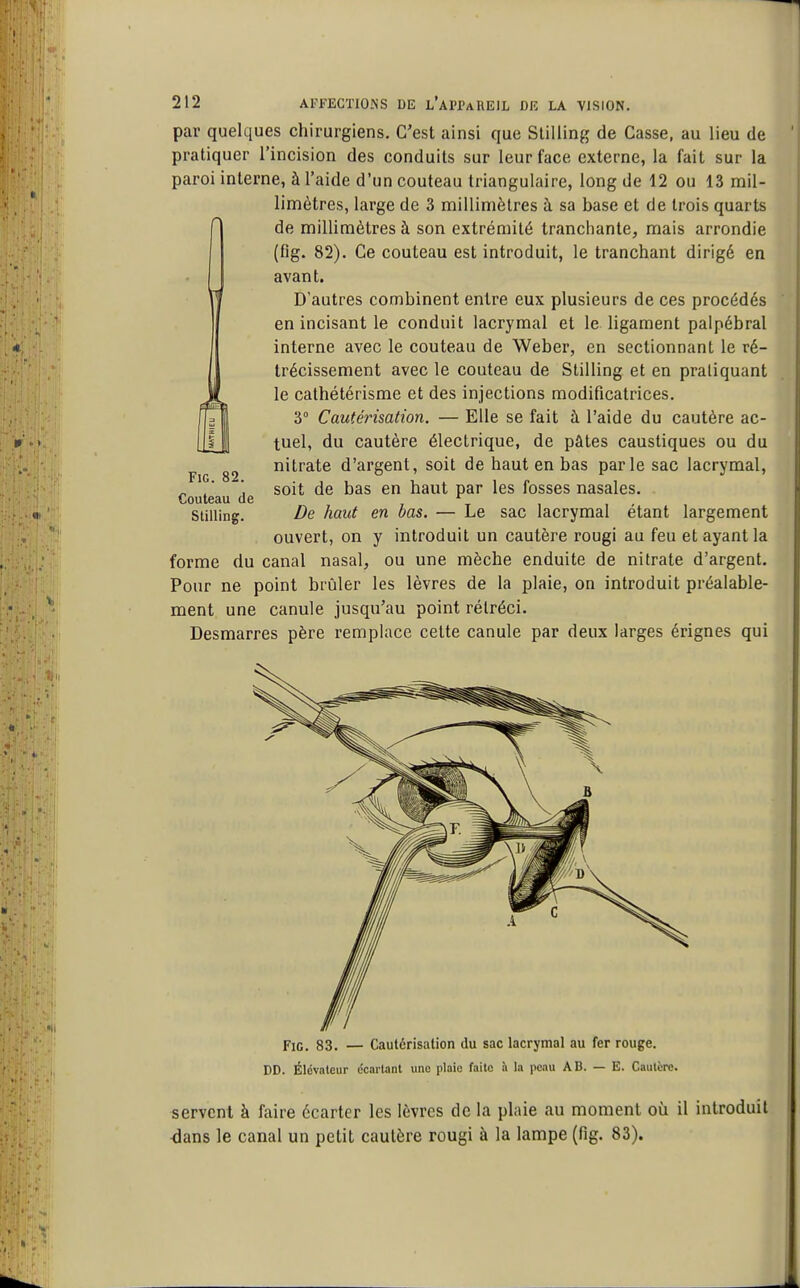 par quelques chirurgiens. C'est ainsi que Slilling de Casse, au lieu de pratiquer l'incision des conduits sur leur face externe, la fait sur la paroi interne, à l'aide d'un couteau triangulaire, long de 12 ou 13 mil- limètres, large de 3 millimètres à sa base et de trois quarts de millimètres à son extrémité tranchante, mais arrondie (fig. 82). Ce couteau est introduit, le tranchant dirigé en avant. D'autres combinent entre eux plusieurs de ces procédés en incisant le conduit lacrymal et le ligament palpébral interne avec le couteau de Weber, en sectionnant le ré- trécissement avec le couteau de Stilling et en praliquant le cathétérisme et des injections modificatrices. 3° Cautérisation. — Elle se fait à l'aide du cautère ac- tuel, du cautère électrique, de pâtes caustiques ou du nitrate d'argent, soit de haut en bas parle sac lacrymal, soit de bas en haut par les fosses nasales. De haut en bas. — Le sac lacrymal étant largement ouvert, on y introduit un cautère rougi au feu et ayant la forme du canal nasal, ou une mèche enduite de nitrate d'argent. Pour ne point brûler les lèvres de la plaie, on introduit préalable- ment une canule jusqu'au point rétréci. Desmarres père remplace celte canule par deux larges érignes qui FiG. 82. Couteau de Stilling. Fie. 83. — Cautérisation du sac lacrymal au fer rouge. DD. Élévateur écartant une plaie faite à la peau AB. — E. Cautère. servent à faire écarter les lèvres de la plaie au moment oîi il introduit ^ans le canal un petit cautère rougi à la lampe (fig. 83).