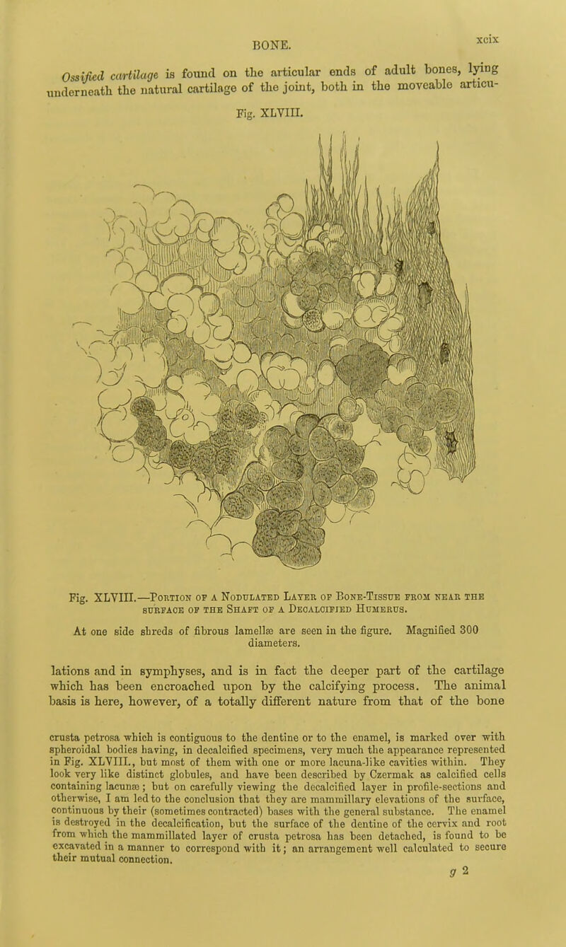 Ossified cartilage is found on the articular ends of adult bones, lying underneath the natural cartilage of the joint, both in the moveable articu- Fig. XLVIII. Fig. XLYin.—PonTioN OF A Nodulated Latek op Bone-Tissue from near the BUKFAOE OF THE ShAFT OP A DeOALOIFIED HUMERUS. At one side shreds of fibrous lamellae are seen in the figure. Magnified 300 diameters. lations and in Bymphyses, and is in fact the deeper part of the cartilage which has been encroached upon by the calcifying process. The animal basis is here, however, of a totally different nature from that of the bone cmsta petrosa ■which is contiguous to the dentine or to the enamel, is marked over -with spheroidal bodies having, in decalcified specimens, very much the appearance represented in Fig. XLVIII., but most of them with one or more lacuna-like cavities within. They look very like distinct globules, and have been described by Czermak as calcified cells containing lacuna); but on carefully viewing the decalcified layer in profile-sections and otherwise, I am led to the conclusion that they are mamiuillary elevations of the .•surface, continuous by their (sometimes contracted) bases with the general substance. The enamel is destroyed in the decalcification, but the surface of the dentine of the cervix and root from which the mammillated layer of crusta petrosa has been detached, is found to be excavated in a manner to correspond with it; an arrangement well calculated to secure their mutual connection