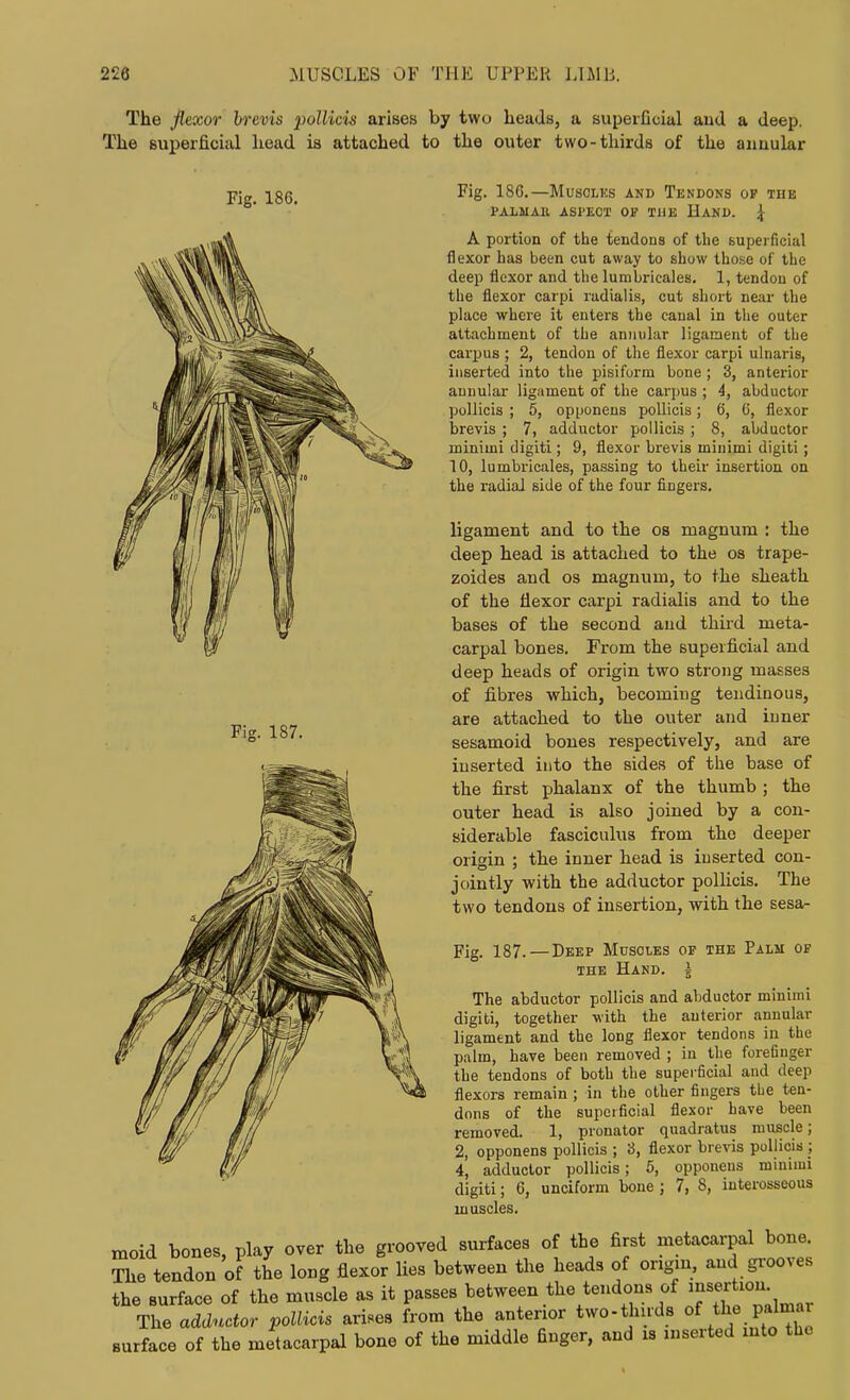 The flexor hrevis pollicis arises by two heads, a superficial aud a deep. The superficial head is attached to the outer two-thirds of the annular Fig. 186. Fig. 187. Fig. 186.—MuscLKs and Tendons op the PALMAU ASPECT OJ? THE HaND. ^ A portion of the tendons of tbe Buperficial flexor has been cut away to show those of the deep flexor and the lumbricales. 1, tendon of the flexor carpi radialis, cut short near the place where it enters the canal in the outer attachment of the annuhir ligament of the carpus ; 2, tendon of the flexor carpi ulnaris, inserted into the pisiform bone ; 3, anterior annular ligament of the carjjus ; 4, abductor pollicis ; 5, opponens pollicis; 6, 6, flexor brevis ; 7, adductor pollicis ; 8, abductor minimi digiti; 9, flexor brevis minimi digiti; 10, lumbricales, passing to their insertion on the radial side of the four fingers. ligament and to the os magnum : the deep head is attached to the os trape- zoides and os magnum, to the sheath of the flexor carpi radialis and to the bases of the second aud third meta- carpal bones. From the superficial and deep heads of origin two strong masses of fibres which, becoming tendinous, are attached to the outer and iuner sesamoid bones respectively, and are inserted into the sides of the base of the first phalanx of the thumb ; the outer head is also joined by a con- siderable fasciculus from the deeper origin ; the inner head is inserted con- jointly with the adductor pollicis. The two tendons of insertion, with the sesa- Fig. 187. — Deep Muscles op the Palm op THE Hand. The abductor pollicis and abductor minimi digiti, together with the anterior annular ligament and the long flexor tendons in the palm, have been removed ; in the forefinger the tendons of both the superficial and deep flexors remain ; in the other fingers the ten- dons of the superficial flexor have been removed. 1, pronator quadratus muscle; 2, opponens pollicis ; 3, flexor brevis pollicis ; 4, adductor pollicis; 5, opponens minimi digiti; 6, unciform bone ; 7, 8, interosseous muscles. moid bones, play over the grooved surfaces of the first metacarpal bone. The tendon of the long flexor lies between the heads of ongm, and grooves the surface of the muscle as it passes between the tendons of 'J^'^^'^- The adductor pollicis ari.es from the anterior two-thuds o( i^e^^Imnv surface of the metacarpal bone of the middle finger, and is inserted mto the