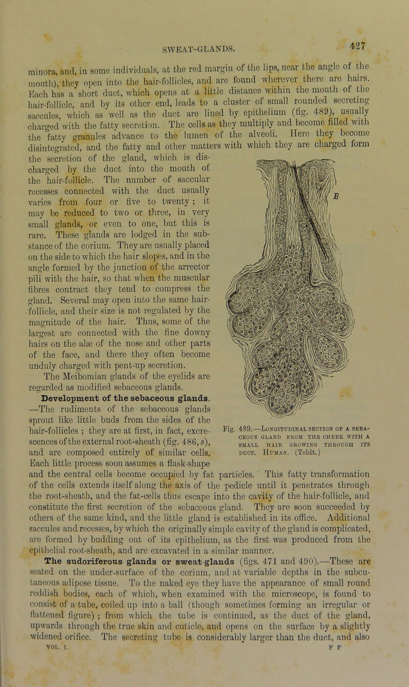SWEAT-GLANDS. minora, and, in some individuals, at the red margin of the lips, near the angle of the mouth) they open into the hair-follicles, and are found wherever there are hairs. Each has a short duct, which opens at a little distance within the mouth ot the hair-follicle, and by its other end, leads to a cluster of small rounded secreting saccules, which as well as the duct are lined by epithelium (fig. 489), usually charged with the fatty secretion. The cells as they multiply and become filled with the fatty granules advance to the lumen of the alveoli. Here they become disintegrated, and the fatty and other matters with which they are charged form the secretion of the gland, which is dis- charged by the duct into the mouth of the hair-follicle. The number of saccular recesses connected with the duct usually varies from four or five to twenty; it may be reduced to two or three, in very small glands, or even to one, but this is rare. These glands are lodged in the sub- stance of the corium. They are usually placed on the side to which the hair slopes, and in the angle formed by the junction of the arrector pili with the hair, so that when the muscular fibres contract they tend to compress the gland. Several may open into the same hair- follicle, and their size is not regulated by the magnitude of the hair. Thus, some of the largest are connected with the fine downy hairs on the alae of the nose and other parts of the face, and there they often become unduly charged with pent-up secretion. The Meibomian glands of the eyelids are regarded as modified sebaceous glands. Development of the sebaceous glands. —The rudiments of the sebaceous glands sprout like little buds from the sides of the hair-follicles ; they are at first, in fact, excre- scences of the external root-sheath (fig. 486, s), and are composed entirely of similar cells. Each little process soon assumes a flask-shape and the central cells become occupied by fat particles. This fatty transformation of the cells extends itself along the axis of the pedicle until it penetrates through the root-sheath, and the fat-cells thus escape into the cavity of the hair-follicle, and constitute the first secretion of the sebaceous gland. They are soon succeeded by others of the same kind, and the little gland is established in its office. Additional saccules and recesses, by which the originally simple cavity of the gland is complicated, are formed by budding out of its epithelium, as the first was produced from the epithelial root-sheath, and are excavated in a similar manner. The sudoriferous glands or sweat glands (figs. 471 and 490).—These are seated on the under-surface of the corium, and at variable depths in the subcu- taneous adipose tissue. To the naked eye they have the appearance of small round reddish bodies, each of which, when examined with the microscope, is found to consist of a tube, coiled up into a ball (though sometimes forming an irregular or flattened figure) ; from which the tube is continued, as the duct of the gland, upwards through the true skin and cuticle, and opens on the surface by a slightly widened orifice. The secreting tube is considerably larger than the duct, and also VOL. I. F F Fig. 489.-—Longitudinal section of a seba- CEOUS GLAND FROM THE CHEEK WITH A SMALL HAIR GROWING THROUGH ITS duct. Human. (Toldt.)
