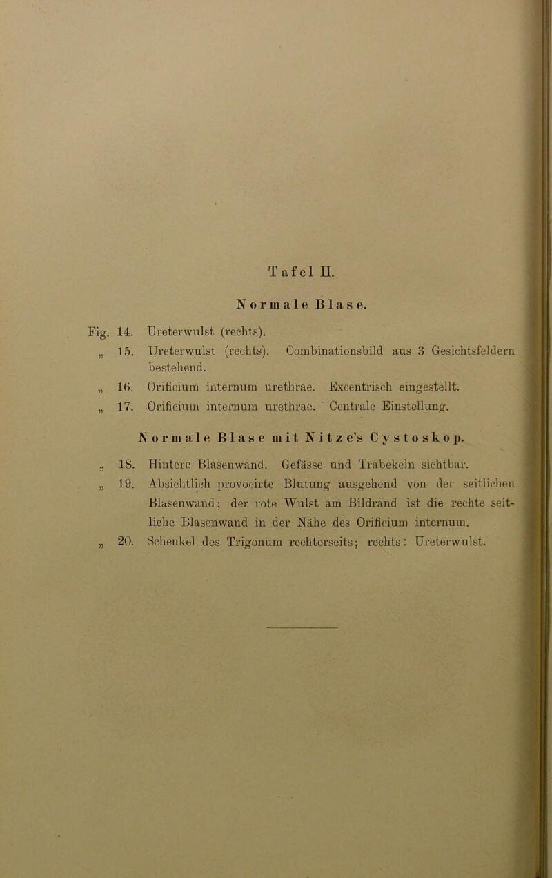 Normale Blase. Fig. 14. „ 15. 16. 17. Ureterwulst (rechts). Ureterwulst (rechts). Coiuhinationsbild aus 3 Gesichtsfeldern bestehend. Orificium internum urethrae. Excentrisch eingestellt. •Orificium internum urethrae. Centrale Einstellung. Normale Blase mit N i t z e’s Cystoskop. 18. Hintere Blasenwand. Gefässe und Trabekeln sichtbar. 19. Absichtlich provocirte Blutung ausgehend von der seitlichen Blasenwand; der rote Wulst am Bildrand ist die rechte seit- liche Blasenwand in der Nähe des Orificium internum. 20. Schenkel des Trigonum rechterseits; rechts: Ureterwulst.