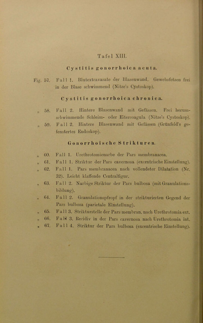 Cystitis gonorrhoica acuta. Fm 57 Fall 1. Blutextravasate der Blasenvvand. Gewebsfetzen frei in der Blase schwimmend (Nitze’s Cystoskop). Cystitis gonorrhoica chronica. „ 58. Fall 2. Hintere Blasenwand mit Gelassen. Frei herum- schwimmende Schleim- oder Eitercoagula (Nitze’s Cystoskop). „ 59. Fall 2. Hintere Blasenwand mit Gefässen (Grünfeld's ge- fenstertes Endoskop). Gonorrhoische S t r i k t u r e n. ,, 60. Fall 1. Urethrotomienarbe der Pars membranacea. „ 61. Fall 1. Striktur der Pars cavernosa (excentrische Einstellung). „ 62. Fall 1. Pars membranacea nach vollendeter Dilatation (Nr. 32). Leicht klaffende Centralfigur. „ 63. Fall 2. Narbige Striktur der Pars bulbosa (mit Granulations- bildung). „ 64. Fall 2. Granulationspfropf in der strikturierten Gegend der Pars bulbosa (parietale Einstellung). „ 65. Fall 3. Strikturstelle der Pars membran. nach Urethrotomiaext. „ 66. FaH 3. Pecidiv in der Pars cavernosa nach Urethrotomia int. „ 67. Fall 4. Striktur der Pars bulbosa (excentrische Einstellung).