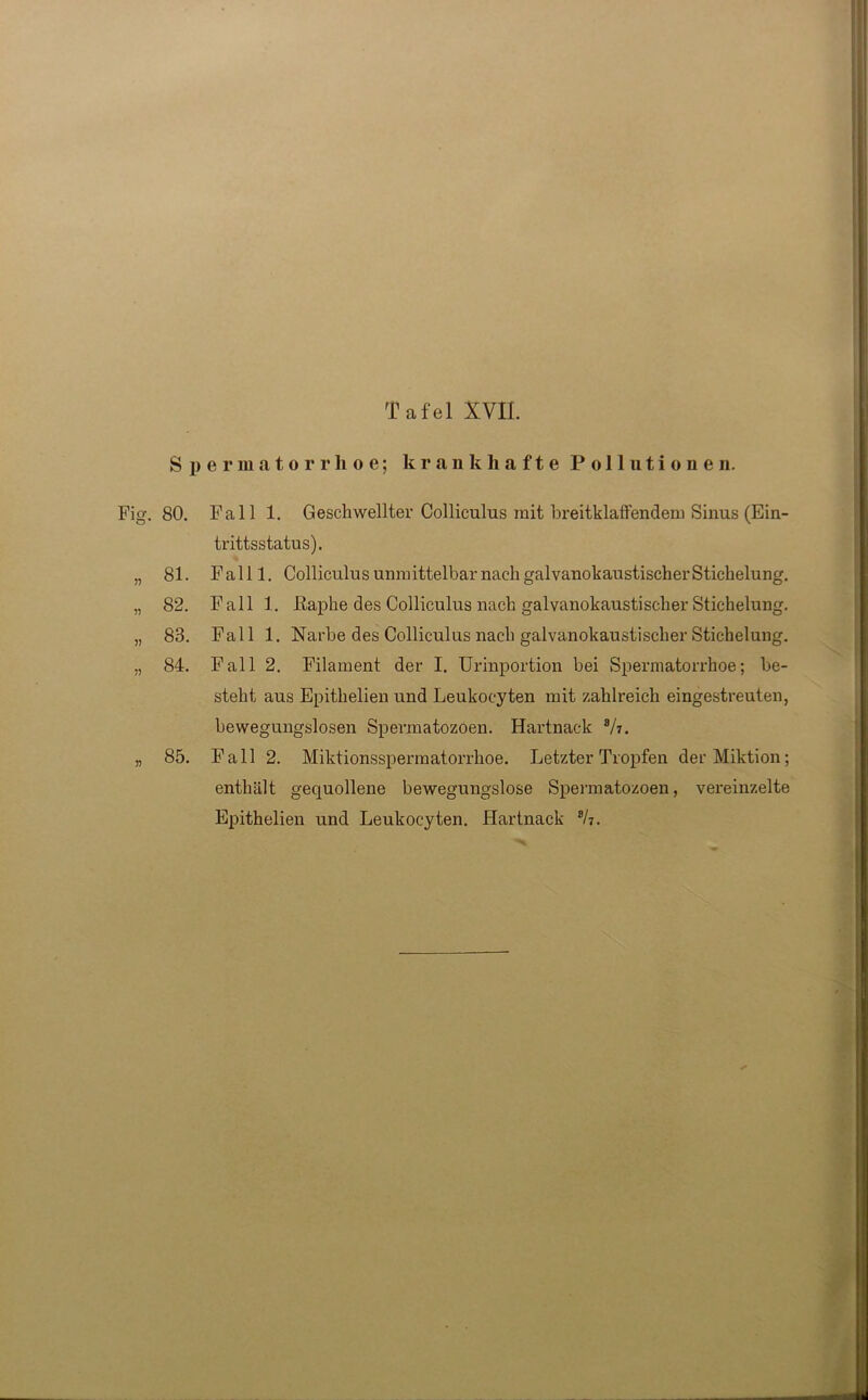 Spermatorrhoe; krankhafte Pollutionen. Fig. 80. 81. 82. 83. 84. 85. Fall 1. Geschwellter Colliculus mit breitklaffendem Sinus (Ein- trittsstatus). Fall 1. Colliculus unmittelbar nach galvanokaustischer Stichelung. Fall 1. ßaphe des Colliculus nach galvanokaustischer Stichelung. Fall 1. Narbe des Colliculus nach galvanokaustischer Stichelung. Fall 2. Filament der I. Urinportion bei Spermatorrhoe; be- steht aus Epithelien und Leukocyten mit zahlreich eingestreuten, bewegungslosen Spermatozoen. Hartnack B/i. Fall 2. Miktionsspermatorrhoe. Letzter Tropfen der Miktion; enthält gequollene bewegungslose Spermatozoen, vereinzelte Epithelien und Leukocyten. Hartnack 8/7.