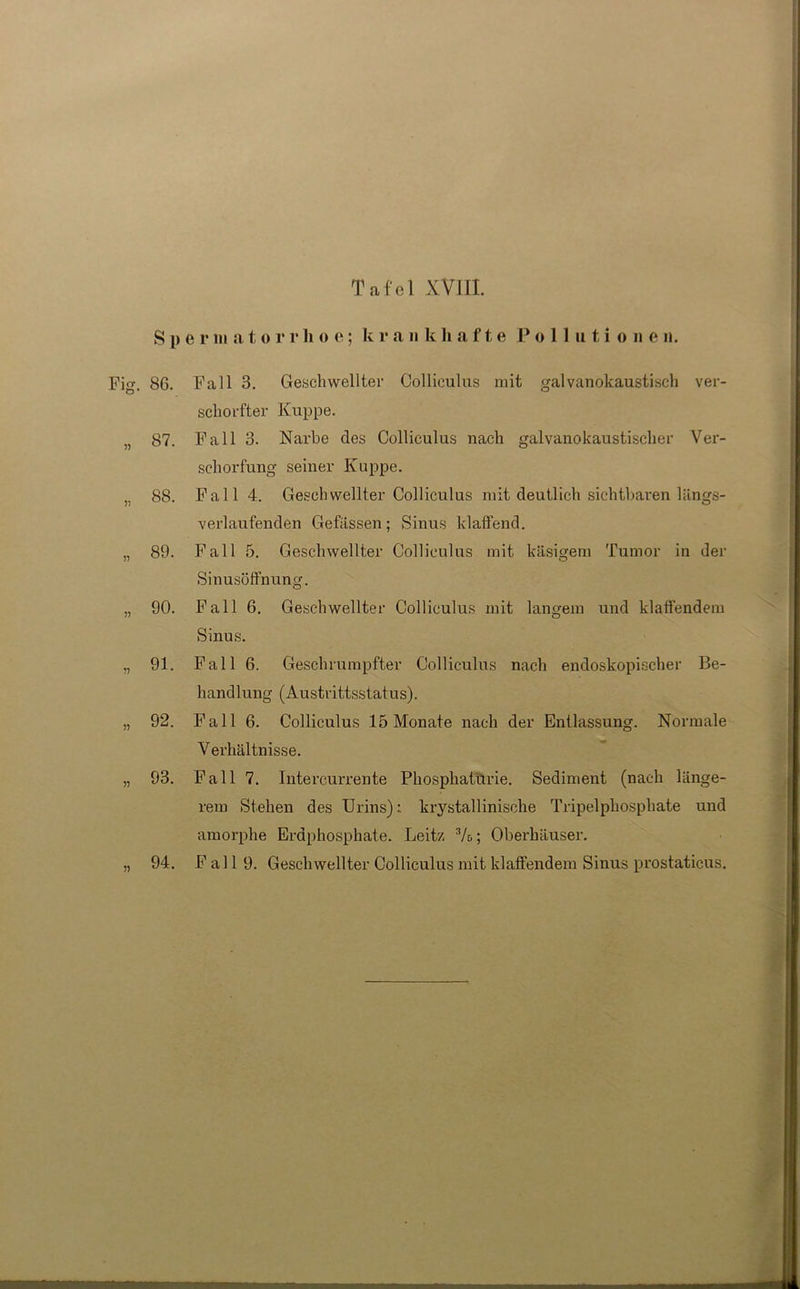 S i) e r m a t, o rrlioe; k r a n k h a f t e Pollutione n. 86. Fall 3. Geschwellter Colliculus mit galvanokaustisch ver- schonter Kuppe. 87. Fall 3. Narbe des Colliculus nach galvanokaustischer Ver- schorfung seiner Kuppe. 88. Fall 4. Geschwellter Colliculus mit deutlich sichtbaren längs- verlaufenden Gefässen; Sinus klaffend. 89. Fall 5. Geschwellter Colliculus mit käsigem Tumor in der Sinusöffnung. 90. Fall 6. Geschwellter Colliculus mit langem und klaffendem Sinus. 91. Fall 6. Geschrumpfter Colliculus nach endoskopischer Be- handlung (Austrittsstatus). 92. Fall 6. Colliculus 15 Monate nach der Entlassung. Normale Verhältnisse. 93. Fall 7. Intercurrente Phosphatürie. Sediment (nach länge- rem Stehen des Urins): krystallinische Tripelphosphate und amorphe Erdphosphate. Leitz 3/&; Oberhäuser. 94. Fall 9. Geschwellter Colliculus mit klaffendem Sinus prostaticus.