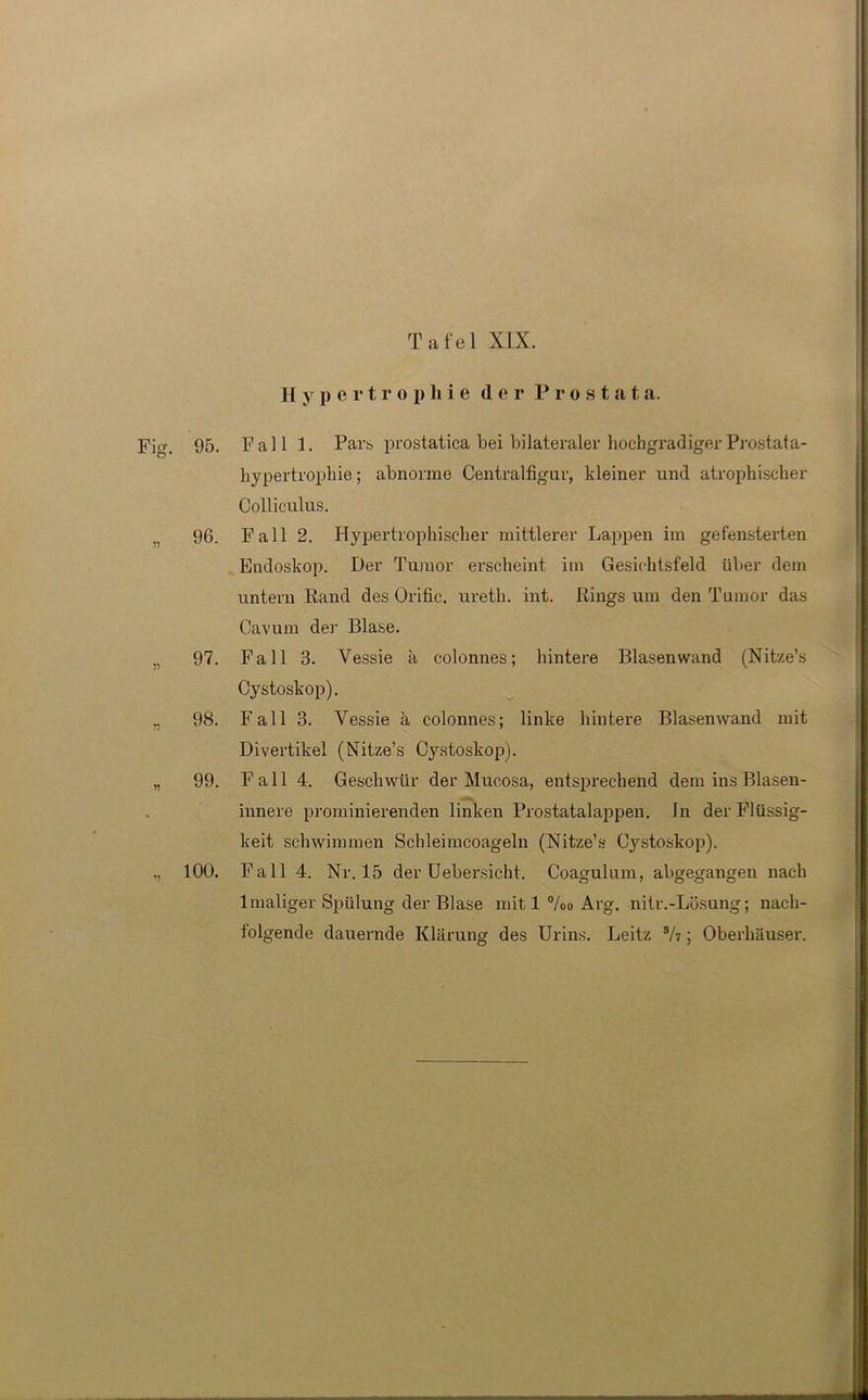 T a f e 1 XIX. H y p e r t r o p h i e der P r o s t a t a. Fi g. 95. Fall 1. Pars prostatica bei bilateraler hochgradiger Prostata- hypertrophie; abnorme Centralfigur, kleiner und atrophischer Colliculus. 96. Fall 2. Hypertrophischer mittlerer Lappen im gefensterten Endoskop. Der Tumor erscheint im Gesichtsfeld über dem untern Rand des Orific. ureth. int. Rings um den Tumor das Cavum de]1 Blase. 97. Fall 3. Vessie a colonnes; hintere Blasenwand (Nitze’s Cystoskop). 98. Fall 3. Vessie ä colonnes; linke hintere Blasenwand mit Divertikel (Nitze’s Cystoskop). 99. Fall 4. Geschwür der Mucosa, entsprechend dem ins Blasen- innere prominierenden linken Prostatalappen. In der Flüssig- keit schwimmen Schleimcoageln (Nitze’s Cystoskop). 100. Fall 4. Nr. 15 der Uebersicht. Coagulum, abgegangen nach 1 maliger Spülung der Blase mit 1 %o Arg. nitr.-Lüsung; nach- folgende dauernde Klärung des Urins. Leitz 3/i; Oberhäuser.