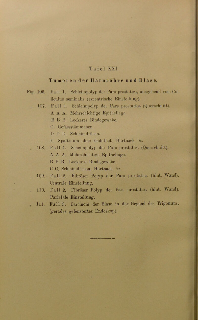 T ii m o r e n de r H a r n r ö li r e u 11 d Blas e. 'ig. 106. 107. 108. 109. 110, 111 Fall 1. Schleimpolyp der Pars prostatica, ausgehend vom Col- liculus seminalis (excentrische Einstellung). Fall 1. Schleimpolyp der Pars prostatica (Querschnitt). A A A. Mehrschichtige Epithellage. B B B. Lockeres Bindegewebe. C. Gefässstiimmchen. D ü D. Schleimdrüsen. E. Spaltraum ohne Endothel. Hartnack l/3. Fall 1. Scheimpolyp der Pars prostatica (Querschnitt). A A A. Mehrschichtige Epithellage. B B B. Lockeres Bindegewebe. C C. Schleimdrüsen. Hartnack l/i. Fall 2. Fibröser Polyp der Pars prostatica (hint. Wand). Centrale Einstellung. Fall 2. Fibröser Polyp der Pars prostatica (hint. Wand). Parietale Einstellung. Fall 3. Carcinom der Blase in der Gegend des Trigonum, (gerades gefenstertes Endoskop).