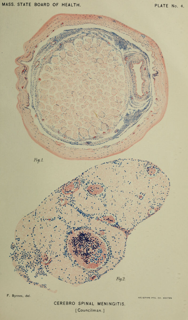 CEREBRO SPINAL MENINGITIS.