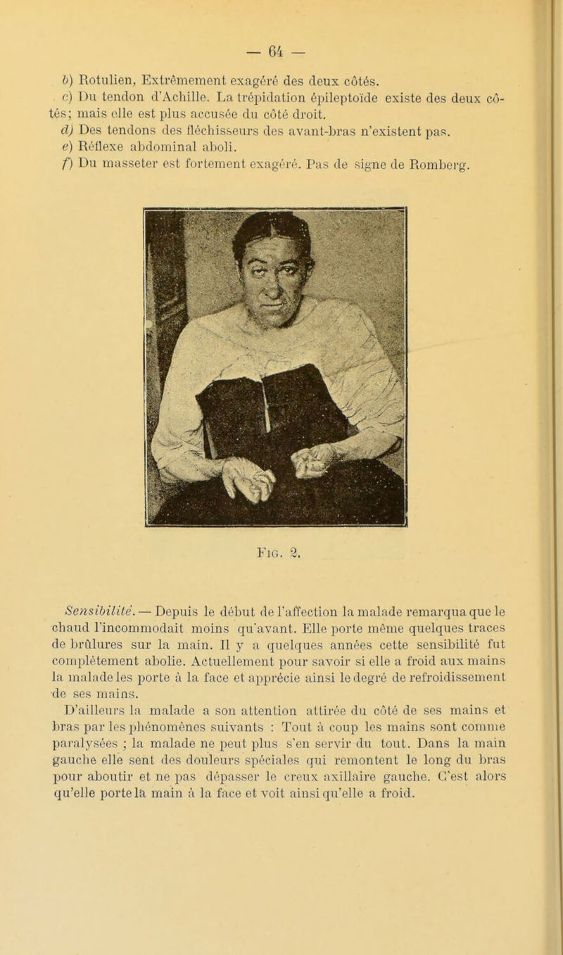 b) Rotiilien, Extrêmement exagéré des deux côtés. c) Du tendon d'Achille. La trépidation épileptoïde existe des deux cô- tés; mais elle est plus accusée du côté droit, d) Des tendons des fléchisseurs des avant-bras n'existent pas. e) Réflexe abdominal aboli, f) Du masseter est fortement exagéré. Pas de signe de Romberg, FiG. 2 Sensibilité. — Depuis le début de TafTection la malade remarqua que le chaud l'incommodait moins qu'avant. Elle porte même quelques traces de brûlures sur la main. Il y a quelques années cette sensibilité fut complètement abolie. Actuellement pour savoir si elle a froid aux mains la malade les porte à la face et apprécie ainsi le degré de refroidissement de ses mains. D'ailleurs la malade a son attention attirée du côté de ses mains et bras par les phénomènes suivants : Tout à coup les mains sont comme paralysées ; la malade ne peut plus s'en servir du tout. Dans la main gauche elle sent des douleurs spéciales qui remontent le long du bras pour aboutir et ne i)as dépasser le creux axillaire gauche. C'est alors qu'elle porte Iti main à la face et voit ainsi qu'elle a froid.
