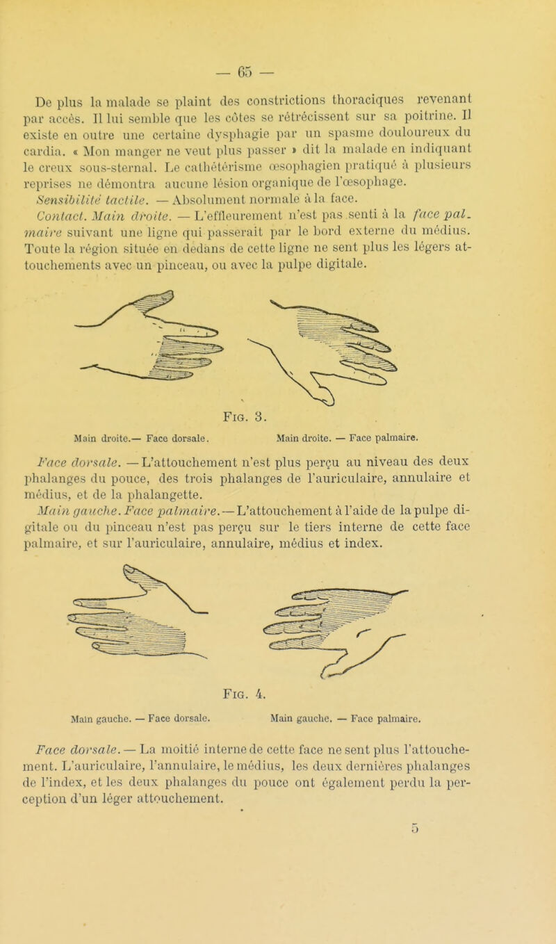 De plus la malade se plaint des constrictions thoraciques revenant par accès. Il lui semble que les côtes se rétrécissent sur sa poitrine. Il existe en outre une certaine dysphagie par un spasme douloureux du cardia. « Mon manger ne veut plus passer i dit la malade en indiquant le creux sous-sternal. Le cathétérisme œsophagien pratiqué à plusieurs reprises ne démontra aucune lésion organique de l'œsophage. Sensibilité laclile. — Absolument normale à la face. Contact. Main droite. — L'eflleurement n'est pas .senti à la face pal. maire suivant une ligne qui passerait par le bord externe du médius. Toute la région située en dedans de cette ligne ne sent plus les légers at- touchements avec un pinceau, ou avec la pulpe digitale. FiG. 3. Main droite.— Face dorsale. Main droite. — Face palmaire. Face dorsale. — L'attouchement n'est plus perçu au niveau des deux phalanges du pouce, des trois phalanges de l'auriculaire, annulaire et médius, et de la phalangette. Mai?î gauche. Face palmaire. — L'attouchement à l'aide de la pulpe di- gitale ou du pinceau n'est pas perçu sur le tiers interne de cette face palmaire, et sur l'auriculaire, annulaire, médius et index. FiG. 4. Main gauche. — Face dorsale. Main gauche. — Face palmaire. Face dorsale. — La moitié interne de cette face ne sent plus l'attouche- ment. L'auriculaire, l'annulaire, le médias, les deux dernières phalanges de l'index, et les deux phalanges du pouce ont également perdu la per- ception d'un léger attouchement. 5