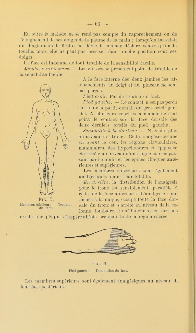 - GG En oulrc la malade ne se rend pas compte du rapprochement ou de réloij^nement de ses doigts de la paume de la main ; lorsqu'on lui saisit un doigt qu'on le llécliit ou dévie la malade déclare sentir qu'on la touche, mais elle ne peut pas préciser dans quelle position sont ses doigts. La face est in<lemne de tout trouble de la sensibilité tactile. Membres inférieurs. — Les cuisses ne présentent point de trouble de la sensibilité tactile. A la face interne des deux jambes les at- toucliements au doigt et au pinceau ne sont ])as perçus. Pied choit. Pas de trouille du tact. Pied gauche. — Le contact n'est pas perçu sur toute la partie dorsale du gros orteil gau- che. A plusieurs reprises la malade ne sent point le contftct sur la face dorsale des deux derniers orteils du pied gauche. Sensibilité à la douleur. — N'existe plus au niveau du tronc. Cette analgésie occupe e)i avant le cou, les régions claviculaires, mammaires, des hypochondres et épigastre et s'arrête au niveau d'une ligne courbe pas- sant par l'ombilic et les épines iliaques anté- rieures et supérieures. Les membres supérieurs sont également analgésiques dans leur totalité. En arriére, la distribution de l'analgésie pour le tronc est sensiblement parallèle à celle de la face antérieure. L'analgésie com- mence à la nuque, occupe toute la face dor- sale du tronc et s'arrête au niveau de la co- lonne lombaire. Immédiatement en dessous existe une pbque d'hypéresthésie occupant toute la région sacrée. Membres inférieurs. —Troubles du tact. FiG. 6. Pied gauche. — Diminution du tact. Les membres supérieurs sont également analgésiques au niveau de leur face postérieure.